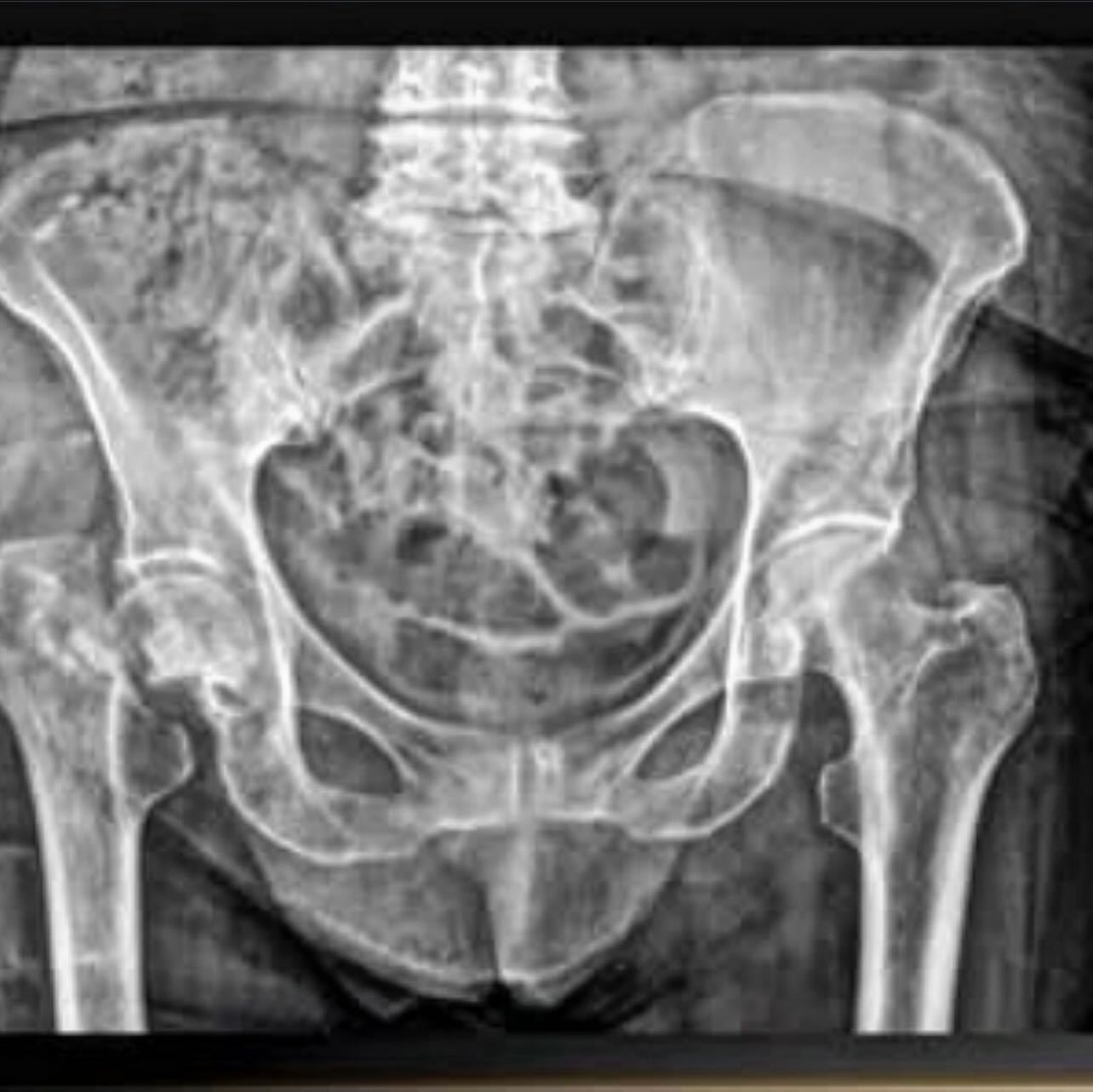 En ocasiones las caídas de nuestra propia altura pueden producir fracturas en la cadera que vienen acompañadas de un dolor intenso e imposibilidad para caminar que deben ser tratadas por un ortopedista.