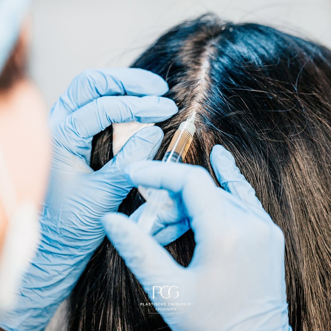 Een gladde, strakke huid willen we allemaal. Maar niet iedereen ziet botox of fillers zitten. Houden de opties dan op? Gelukkig niet! Bij PCG kun je terecht voor de natuurlijke anti-agingbehandeling PRP. Dit staat voor Platelet Rich Plasma en verjongt en verbetert de huid met gebruik van eigen bloed. Ook wordt PRP ingezet om haarverlies tegen te gaan en de haargroei te stimuleren. Benieuwd hoe PRP in zijn werk gaat en wat de resultaten van deze behandeling zijn? Plan dan snel een vrijblijvend consult!
📞: 050 - 211 04 96
💌: info@pcgroningen.nl#