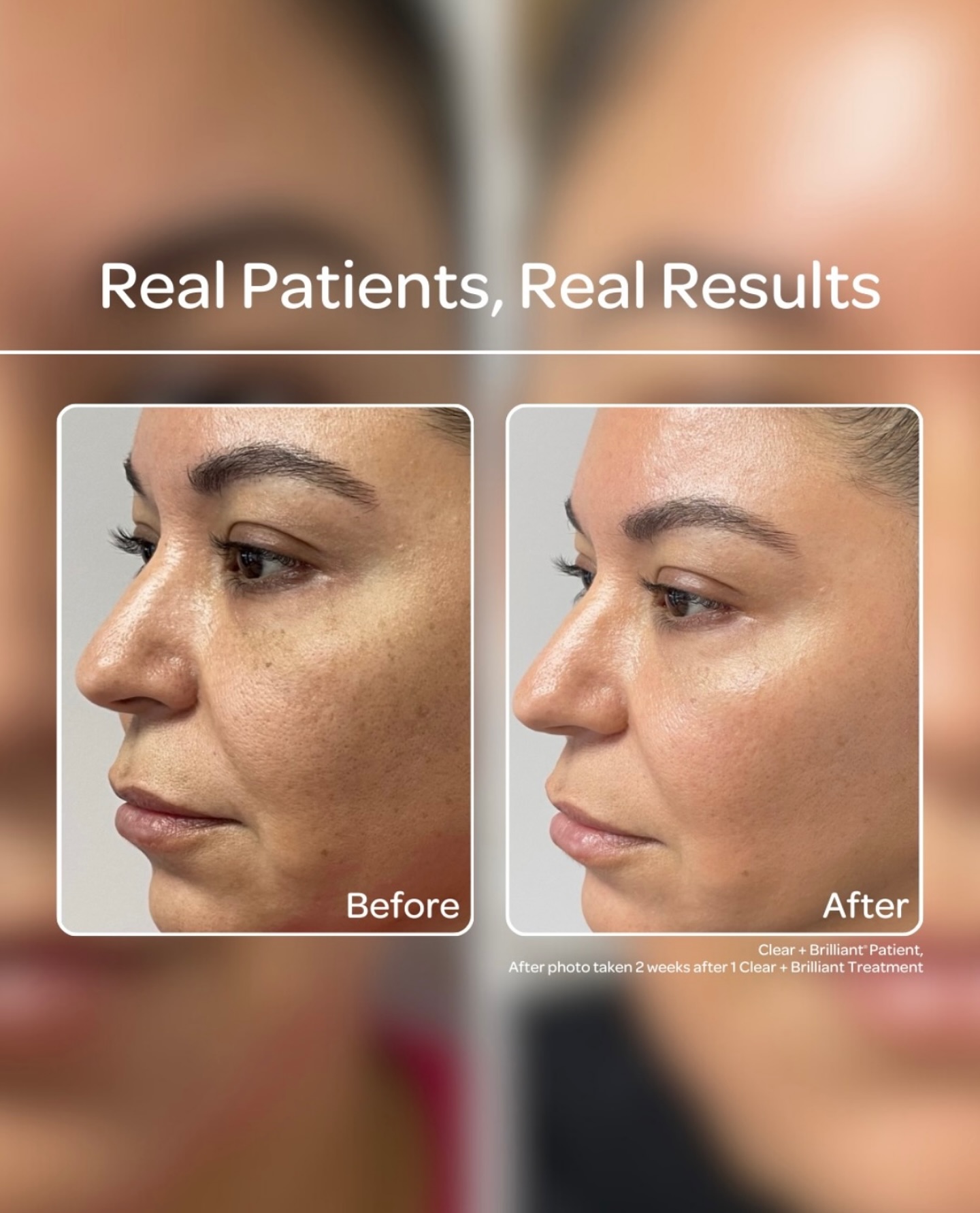 Achieve smoother, more radiant skin with Clear and Brilliant Laser! Expect refined pores, reduced fine lines, and a visibly glowing complexion. Notice the difference after just one session—perfect for a refreshed, youthful look! Ready for your skin’s transformation? If yes, book your first session here today: www.montecosmet.com/clear-and-brilliant-laser-london
#ClearAndBrilliant #SkinRenewal #FlawlessComplexion #RadiantGlow #LaserResults