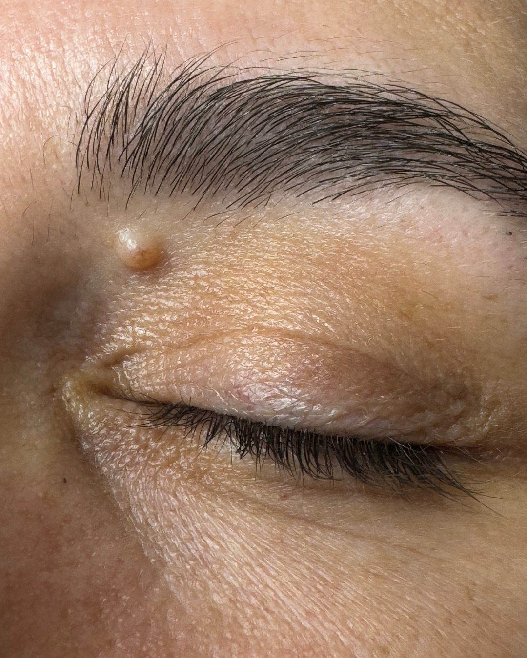 If you have a blemish or mole like these ones and would like to get it checked out or potentially removed, follow these steps!👇🏼
1. Discover The Expert Skin Clinic, a leading destination for mole and blemish treatment in Northampton.
2. Book a consultation to get it checked out! You can do this on our website by clicking the 'Book Now' button in the top right corner of our website.
-If you think your mole or blemish has changed recently or are concerned about the nature of it, book the 'mole/lesion screening'. This is our 'Map My Mole' service where we use a professional grade dermatoscope to examine the blemish and send it to a dermatologist for a closer look.
-If you're unsure what the blemish is or you know what it is and would like it removed, book our 'skin blemish consultation'. This will determine what it is and how best it can be removed or reduced.
3. Depending on which type of consultation you had and the outcome of it, it's now time to await the results or book in for your treatment.
We understand that it can sometimes be intimidating when you have a blemish or mole but don't know how to go about getting it seen to or removed. Just get in touch if you have any further questions and we can help!
#moleremoval #molereduction #moleremovalnorthampton #blemishremoval #northamptonskin #skinclinicnorthampton