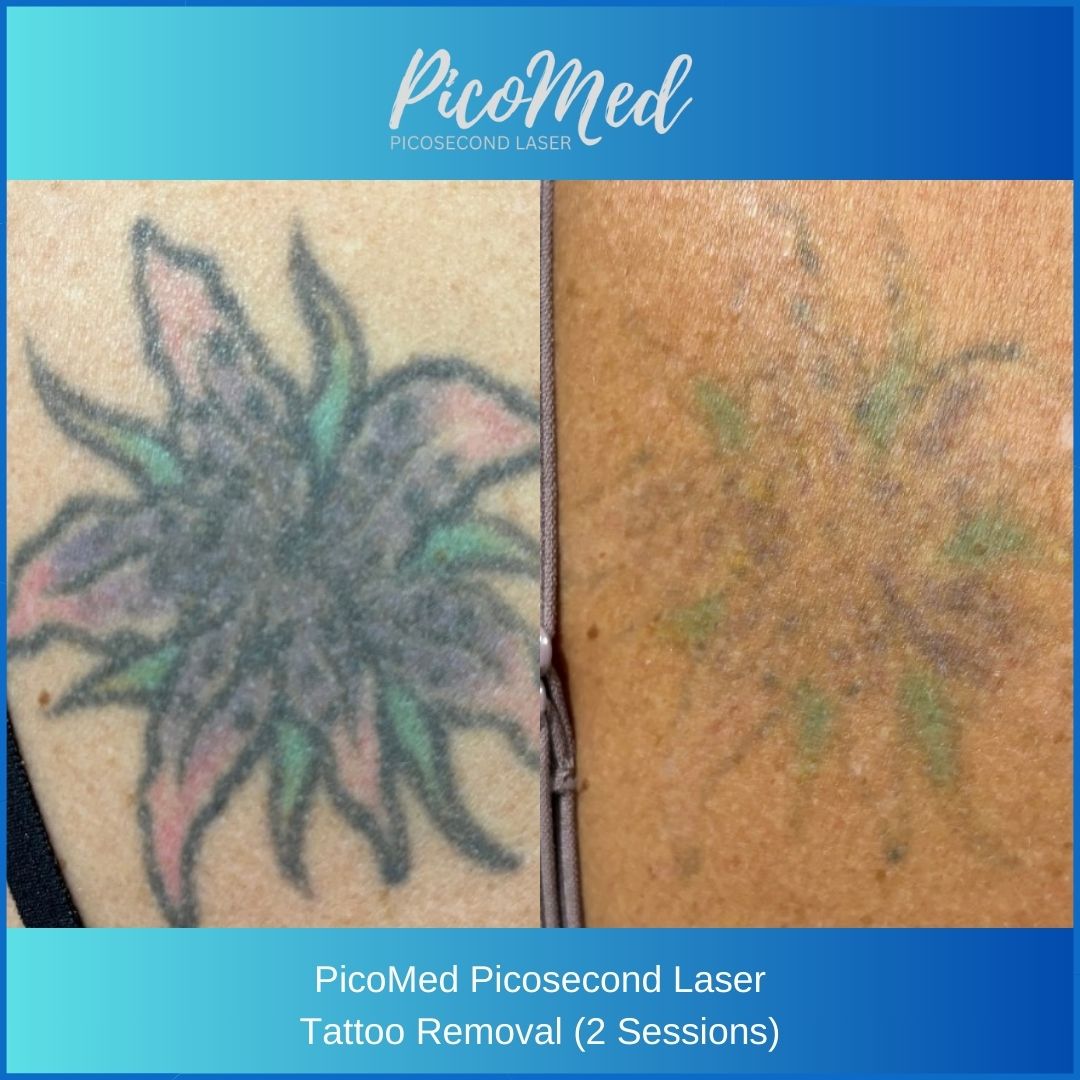 💎Client Success Story 💎
✨ **PicoMed ** ✨ Is the brand new state of the art 2025 technology Picosecond Laser Device!
Have a look at these amazing results in just 2 treatments!
Contact us for more information 📲