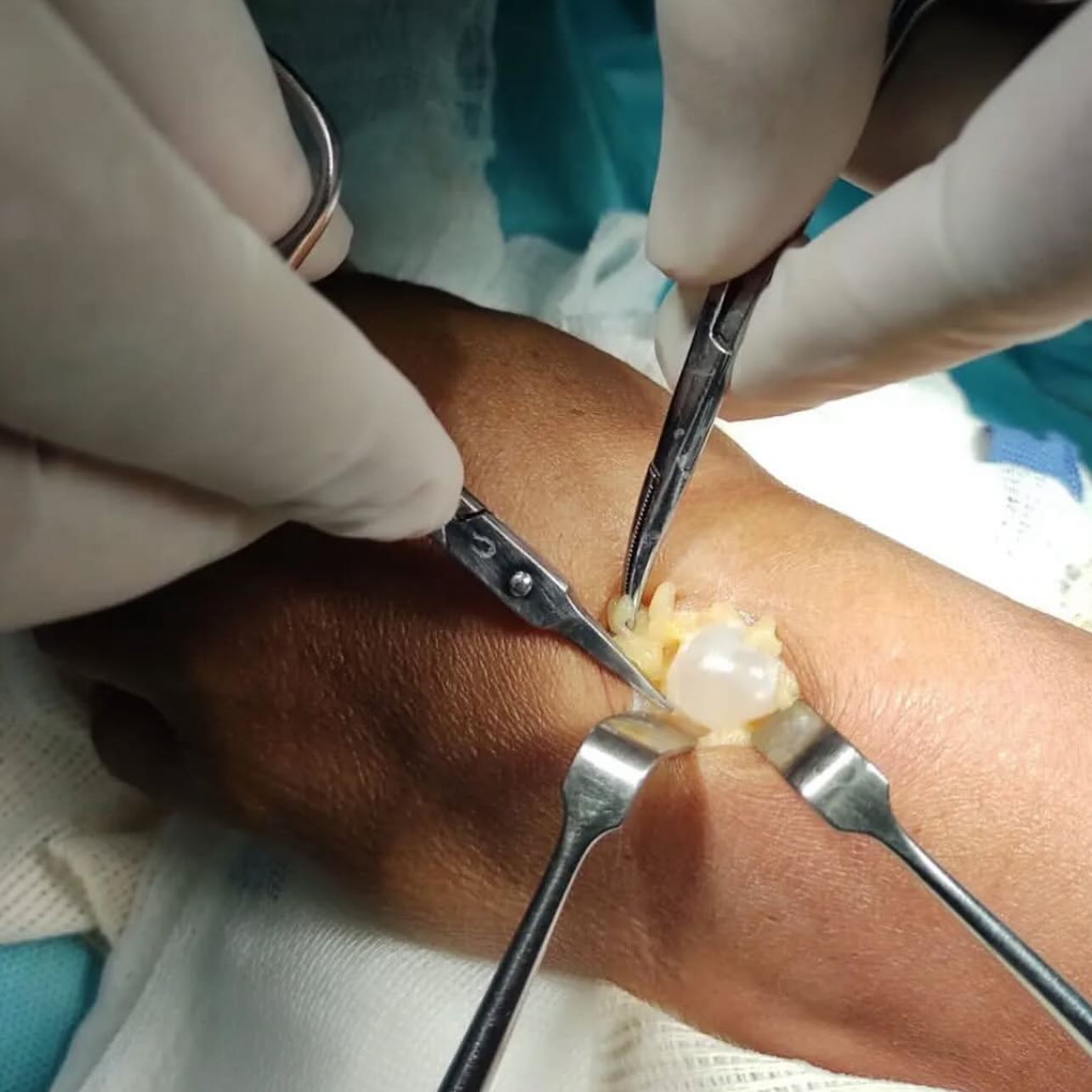 El quiste sinovial o ganglión es una tumoracion benigna que se forma por la acumulación de líquido sinovial en las articulaciones, puede llegar a causar dolor y abultamiento.