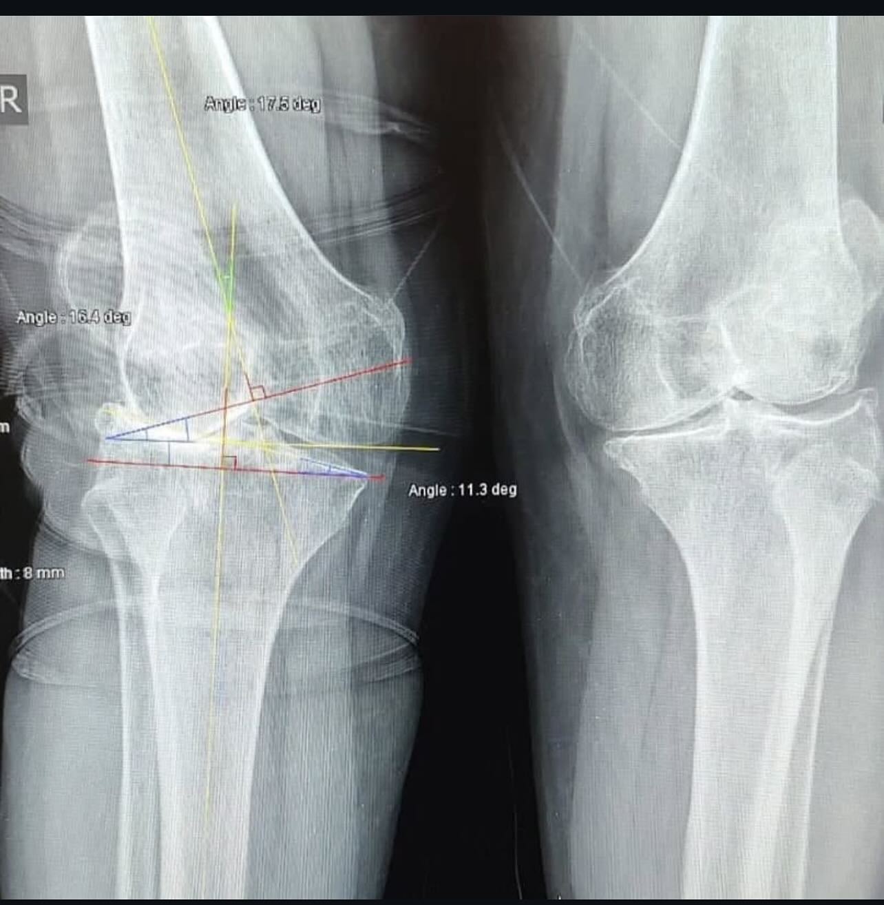 La Gonartrosis o artrosis de rodilla es un desgaste del cartílago que recubre los huesos de la rodilla, viene acompañado de dolor y limita la movilidad, en ocasiones puede venir acompañado de una deformidad, un grado avanzado de Gonartrosis puede requerir la colocación de prótesis como tratamiento.