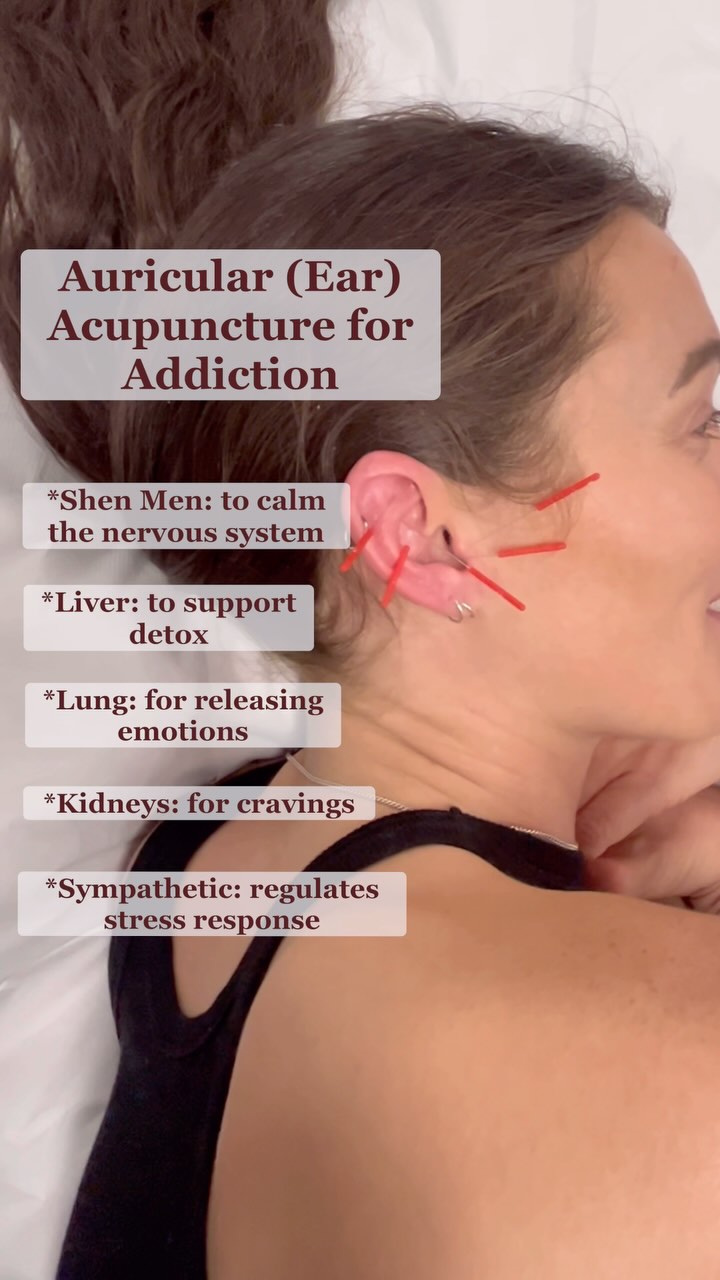 Auricular acupuncture offers one of the most direct ways to regulate the nervous system and support deep, whole-body healing—both physically and emotionally.
Used worldwide, the NADA protocol (National Acupuncture Detoxification Association) is a powerful 5-point auricular treatment designed to support those experiencing stress, trauma, addiction, and withdrawal.
👉The five points used in the NADA protocol:
• Shen Men – calms the spirit and supports emotional balance
• Sympathetic Point – helps reset the nervous system and relieve pain
• Kidney – supports willpower, vitality, and adrenal function
• Liver – clears heat, detoxifies, and aids in processing anger or frustration
• Lung – promotes letting go, boosts immunity, and helps release grief
💆♀️ This protocal can also be used more generally to support the body’s ability to reset, restore, and recover.
#auricularacupuncture #nadaacupuncture #earacupuncture #addictionrecovery #acupunctureworks #nervoussystemhealth #tcm #traumarecovery #chinesemedicine #acupunctureforhealing #holistichealing #naturalrecovery #naturopathicmedicine #emotionalwellness #stressrelief
