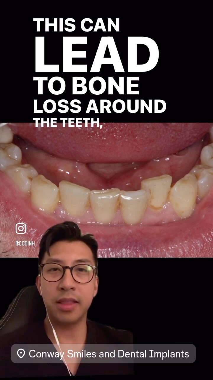 🗣️ You’re never too old to start Invisalign! Check out this case that was completed on a 75 year old patient. Lower crowding like this is common in all ages and is easily fixable with #invisalign . This can prevent future problems such as bone loss and gum disease. Not only will you have a healthier smile, it will look great as well! 😬✨
#orlandodentist #orlandoinvisalign #invisalignorlando