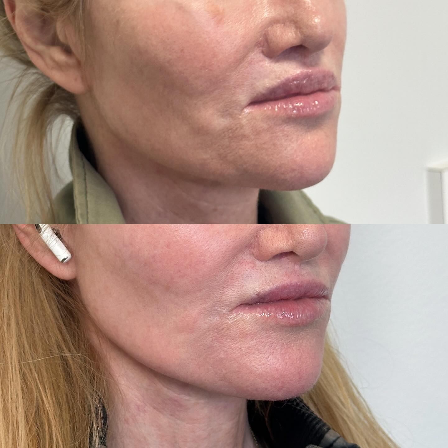 My favorite magic trick is enhancing someone’s appearance with the opposite of what they thought they needed. Many patients come in asking for more filler without understanding what other factors are contributing to that assessment. While a patient can see an area of hollowness, there must also be an assessment on what might be causing the fullness next to it, creating this illusion.
The combination of dissolving unwanted filler and tightening both deep and superficial layers of skin gave a significantly improved appearance to the full face (though I could only show the lower portion here!).
Did she have to trust the process? Absolutely yes. but a series of treatments got us to this point and we couldn’t be happier.