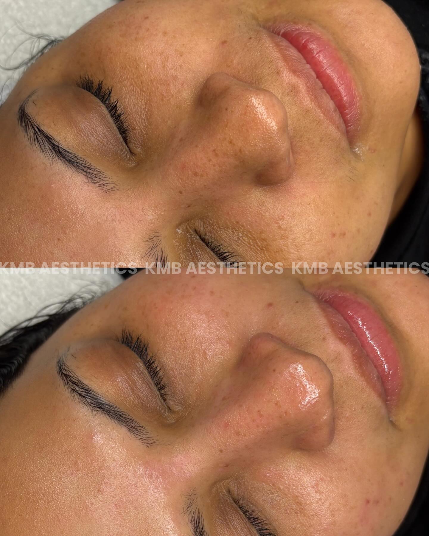 Straight from the story to the feed 📸
A instant before & after of a 75 minute, fully customized professional treatment including a variety of Medical- grade skincare & advanced modalities🤍.
Focusing on decongesting & brightening the skin✨
🚨 DISCLAIMER : Instant results are not guaranteed in every treatment, especially more invasive treatments. Real results happen over time, days after your treatments with me. HOWEVER, expect instant relief, after every treatment. Wether that be, more soothed skin, decongested skin, smoother skin, healing skin❤️🩹
#ChristianEsthetician #ChristianBusiness #ChristianSkincareBusiness #BrowardEsthetician #browardfacials #browardacnespecialist #browardacneclinic #browardfacialist #facerealityskincare #esthiebestie #estheticianlife #esthetics