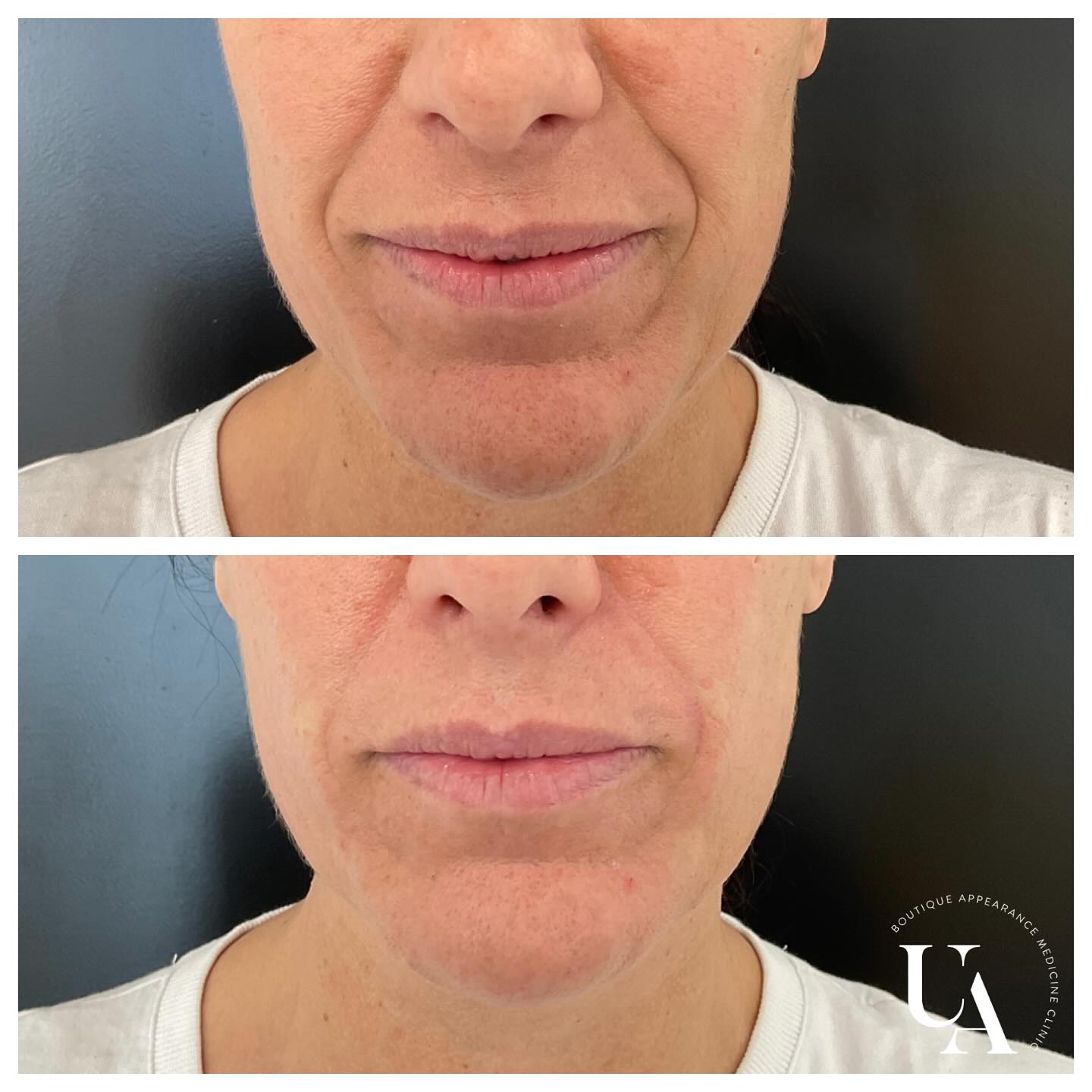 Naturally refreshed! 😍
Thank you to my lovely lady for allowing me to share ❤️❤️
*individual results vary*
Dermal filler injections are Medical devices for the treatment of loss of volume in the skin. Dermal fillers have risks and benefits. Ask your doctor if dermal filler injections are is right for you. For further information ask your doctor or go to www.medsafe.govt.nz
#dermalfiller #naturalresults #kapiti #uniqueaesthetics_byrachel #lovemyjob