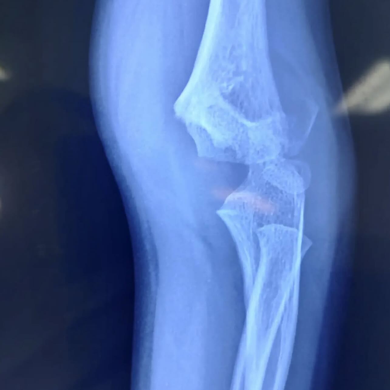 Las fracturas de codo en pacientes pediatricos deben ser tratadas por un traumatólogo ya que pueden ocasionar secuelas como deformidad y limitación funcional.