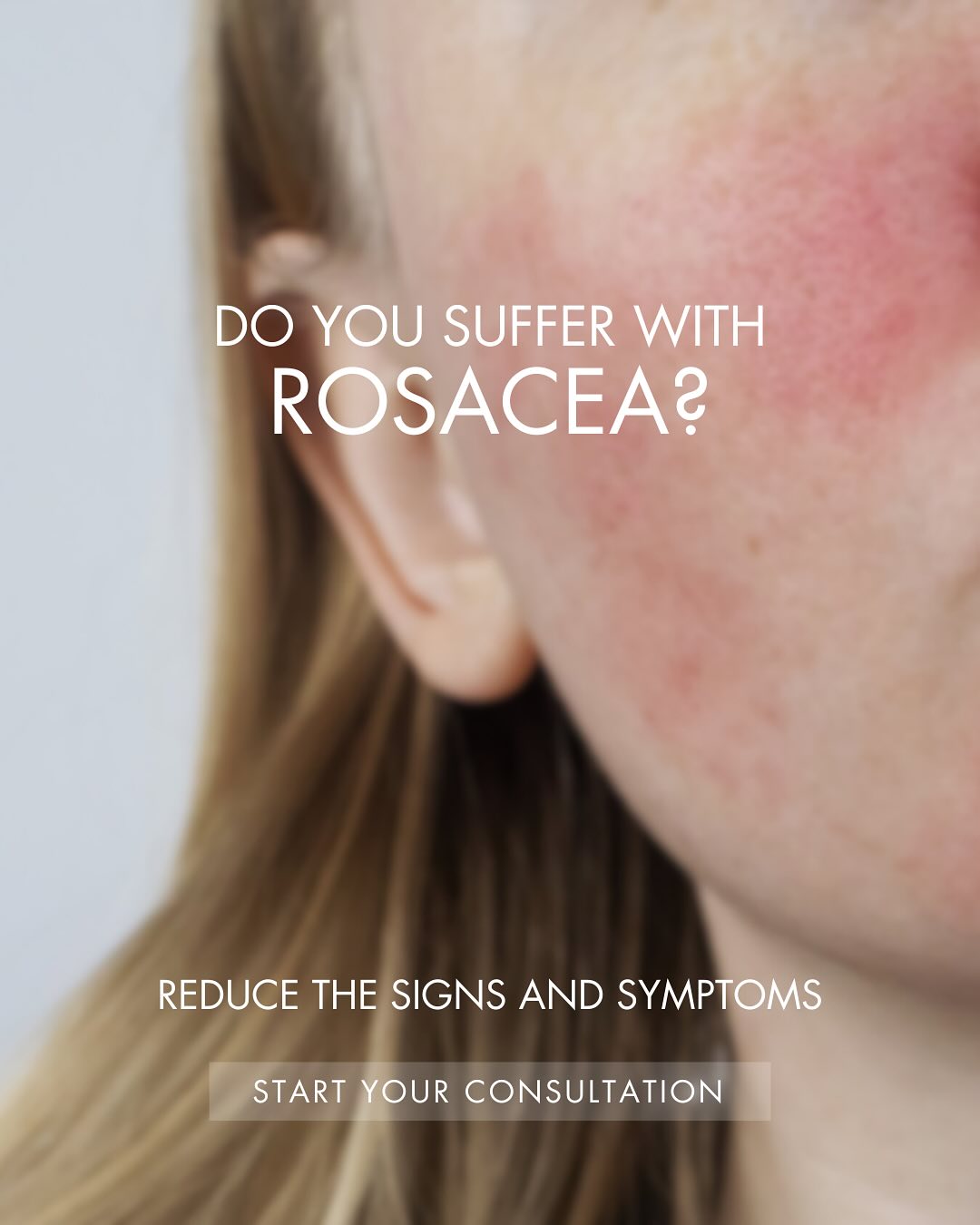What is rosacea?
Rosacea is a common chronic skin condition that mainly affects the face. It causes redness, pimples, broken blood vessels, and may also involve the eyes. Symptoms can flare for weeks to months and then go away for a while. April is rosacea awareness month and we have put together a facial and course offer to help combat your redness concerns.
Rosacea Facial 1hr £70
Course of 5 Rosacea Facials with 1 free £350
Facial includes; 2 cleanses, Microdermabrasion, Oxygen, LED Light Therapy, Skin Repair Mask & Moisturise with SPF
For more information please get in touch. Serenity Spa
#rosacea #skin #skincareroutine #skingoals #skintreatment #crystalclearskincare #facial #rosaceaawarenessmonth #glow #formby #liverpool #southport #beautysalon #bestbeautysalon