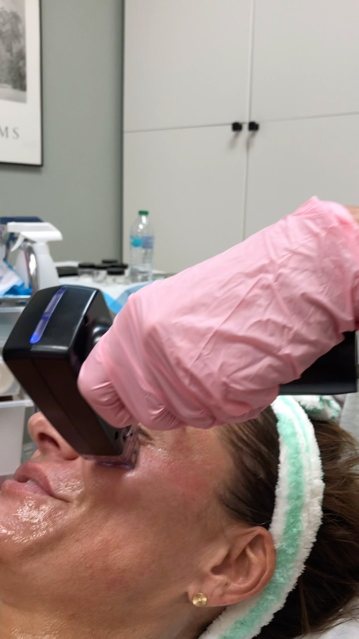 Curious about Morpheus8? 💫
Morpheus8 is an effective, non-invasive treatment ideal for full-body skin resurfacing, and tightening.
Using advanced fractional radiofrequency (RF) energy, it rejuvenates and remodels the skin without downtime, or a painful recovery!
Ready to learn more? Call or DM us!
#Morpheus8 #SkinRejuvenation #NonInvasiveBeauty #DrDuponAesthetics #LookAndFeelYourBest