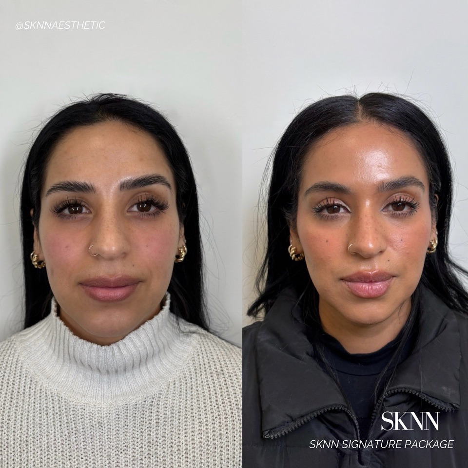 ONE MONTH HEALED full upper face Botox, cheek and lip filler! The power of how Botox and filler can balance out your natural features to create a natural looking contoured, youthful, and slimming look ✨💉🪞
Filler Treatment Areas
•Cheeks
• Lips
Botox Treatment Areas:
•Full Upper Face
Book your appointment now in our bio!
Sknn Aesthetics | Tricities Medical Spa
📍 West Pasco
#nurseinjectortricities #antiagaing #skincare #lipfiller #lipfillertricities #cheekfiller #facialbalancing #tricitieswa #pascowa #nurseinjector #medicalspa