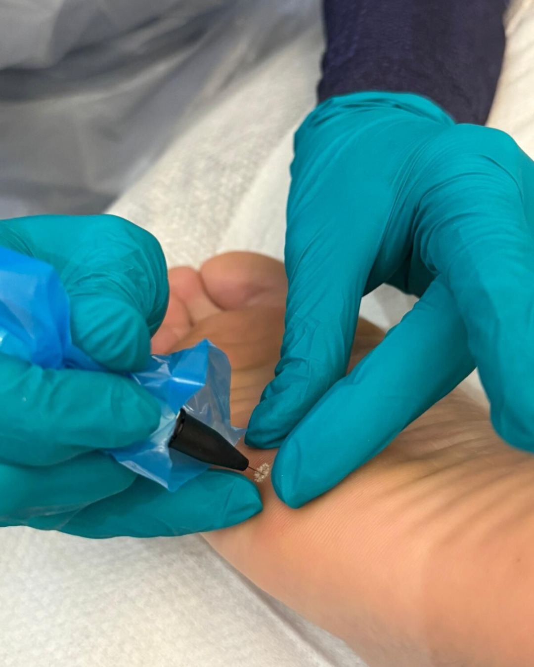 Take a deeper dive into our two main methods of mole or blemish removal...
👉🏼 Advanced Electrolysis (Otherwise known as Advanced Cosmetic Procedure or ACP)
-This is one of the least invasive and most reliable methods of blemish removal. It uses a small heated probe to cauterise and lift away the mole or blemish until it is completely removed or reduced.
👉🏼 Cryotherapy
-This is a highly effective, quick treatment with minimal downtime. It uses liquified nitrous oxide to freeze and break down the blemish until it is removed.
Your consultation will determine which method is most suitable for your skin and blemish type. Both treatments may require multiple sessions depending on the size of the blemish but we will always review the success of the treatment after 12 weeks.
Read more about each treatment on our website!
#blemishremoval #advancedelectrolysis #cryotherapy #skintreatmentnorthampton #northamptonskin