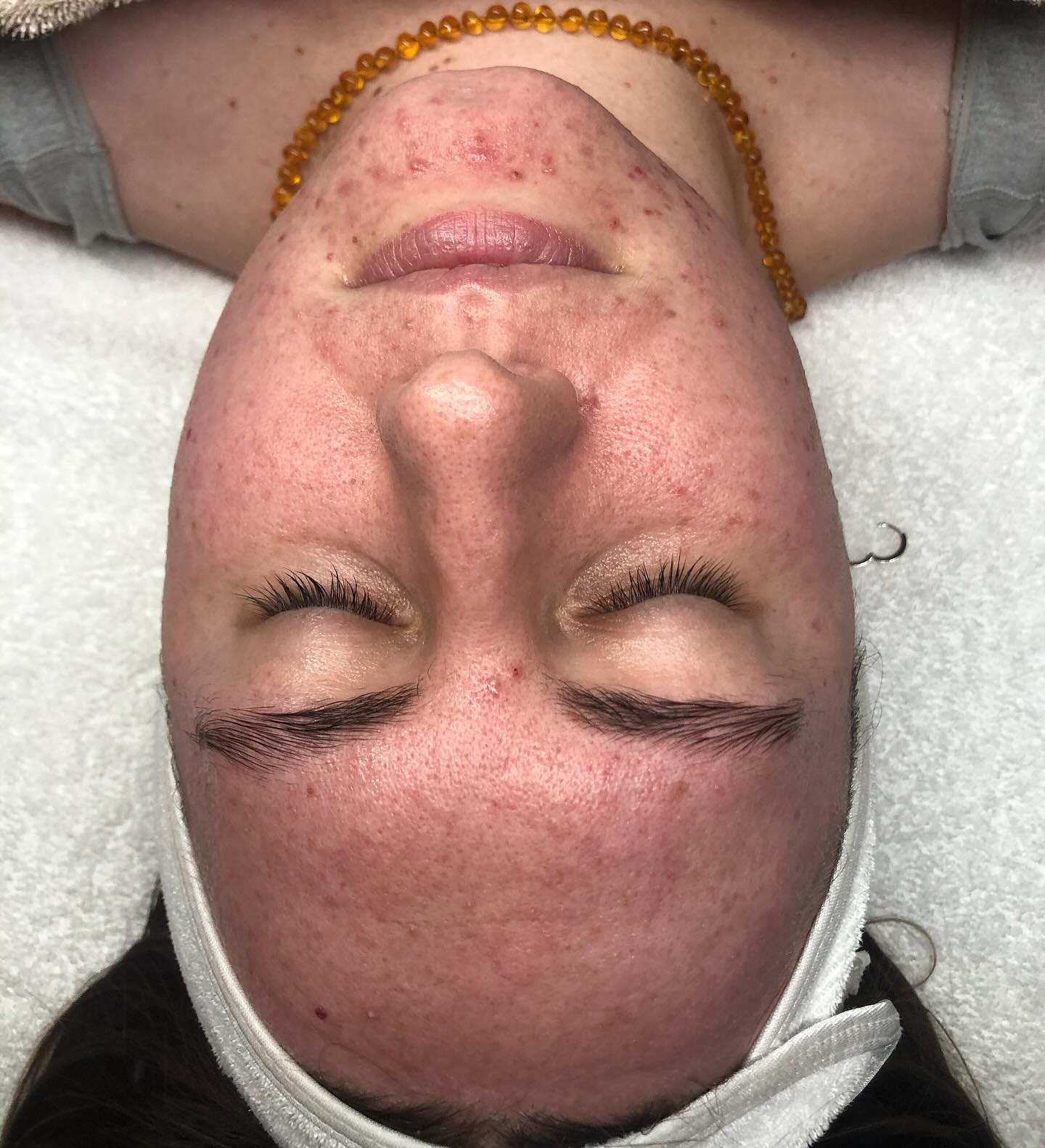 Swipe to see this amazing skin transformation 🤎
This journey took 8 months of dedication, patience, and the right skin treatments!
When we started in July 2024, our goal was to first calm the breakouts before moving into advanced treatments like skin needling. And after months of customized facials, LED therapy, and a tailored skincare routine, we finally reached our milestone in March 2025-clear, healthy skin ready for the next level!
If you’re struggling with acne, know that lasting results take time-but with the right plan, you CAN achieve clear, glowing skin.
#clearskin #blemishfree #acnetreatment #melbourneskintreatment #glowingskintips #loxtoxskincare #kokoshbeautyskinwellness