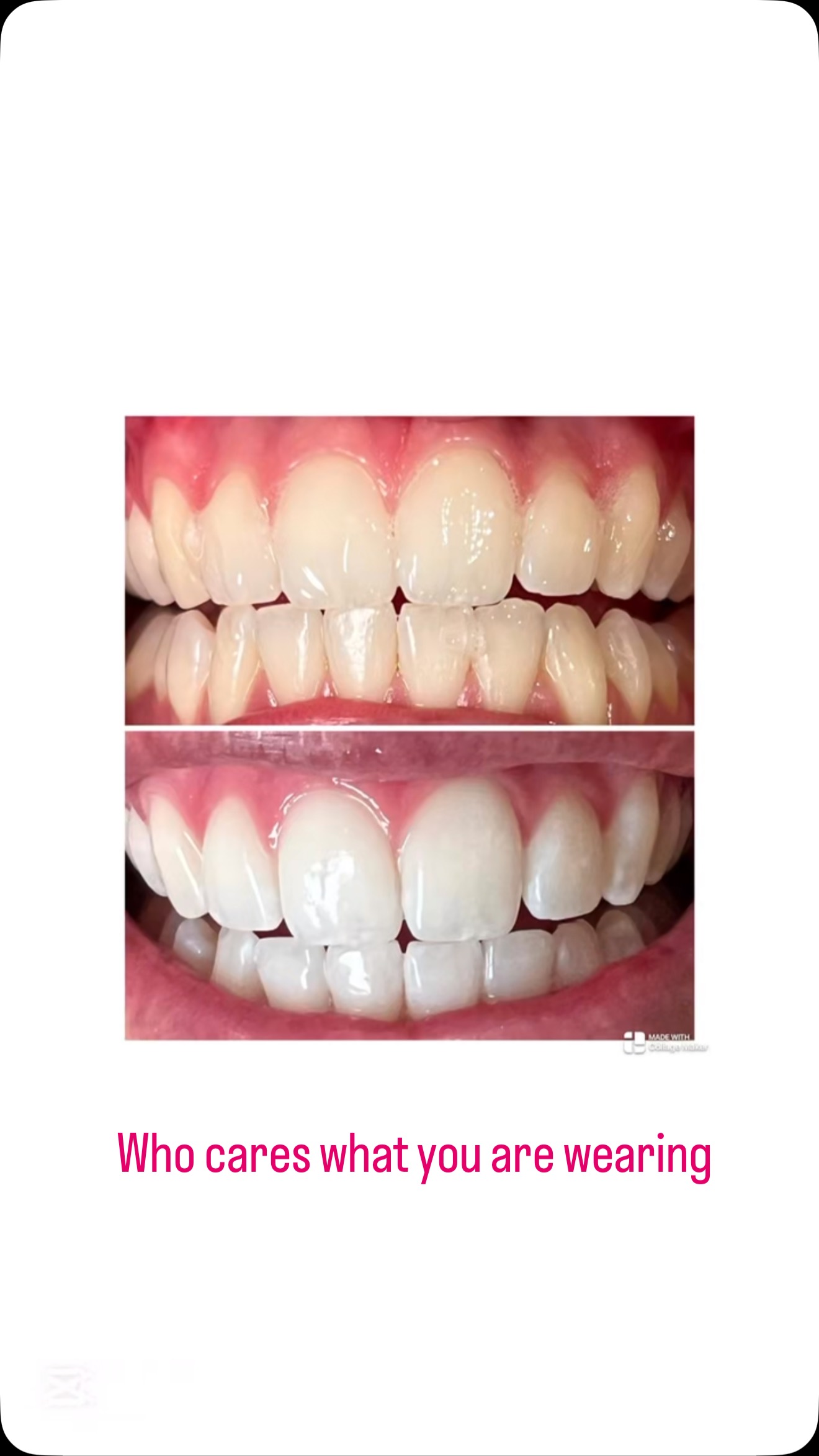 Who cares what you’re wearing when your smile steals the show? ✨ A bright, white smile is the best accessory—timeless, effortless, and impossible to ignore!
Get up to 18 shades whiter in just one session.
A bright white smile is the ultimate confidence booster—because when you shine, you own the room!
Ready to glow? 😁💎
#GlowUp #TeethWhitening #SmileGoals #ConfidenceBoost #TeethWhitening #Illawarra #Wollongong #LaBelleSkinTherapy
