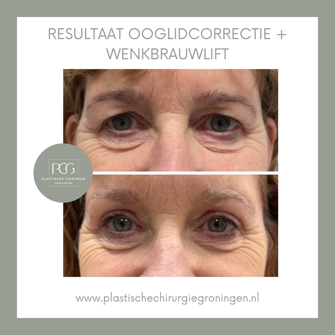 Een mooi natuurlijk resultaat van een bovenooglidcorrectie + wenkbrauwlift 🤍✨
Foto 1: Voor de operatie.
Foto 2: Zes weken na de operatie.
Overweegt u ook een behandeling bij ons of wilt u graag meer informatie? Neem dan gerust contact met ons op!
📞: 050 - 211 04 96
💌: info@pcgroningen.nl