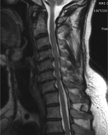 La enfermedad discal degenerativa cervical puede venir acompañada de una deformidad de la columna y producir compresión de la médula o raíces nerviosas ocasionando dolor, en casos selectivos esto se puede tratar con medicina regenerativa mejorando el dolor y la función.
