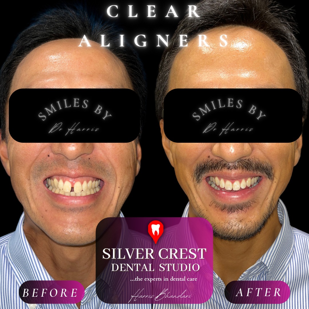 ♦Sapphire Package♦
A round of Invisalign, followed by Composite Edge Bonding is one of the most effective and comprehensive ways to get a dazzling yet healthy new smile!!
DM us today to book your Invisalign consult with us!
#invisalign #aligners #teethstraightening #smilemakeover #teethgap #newsmile #smilesaturday #invisalignsmile #compositebonding #composite