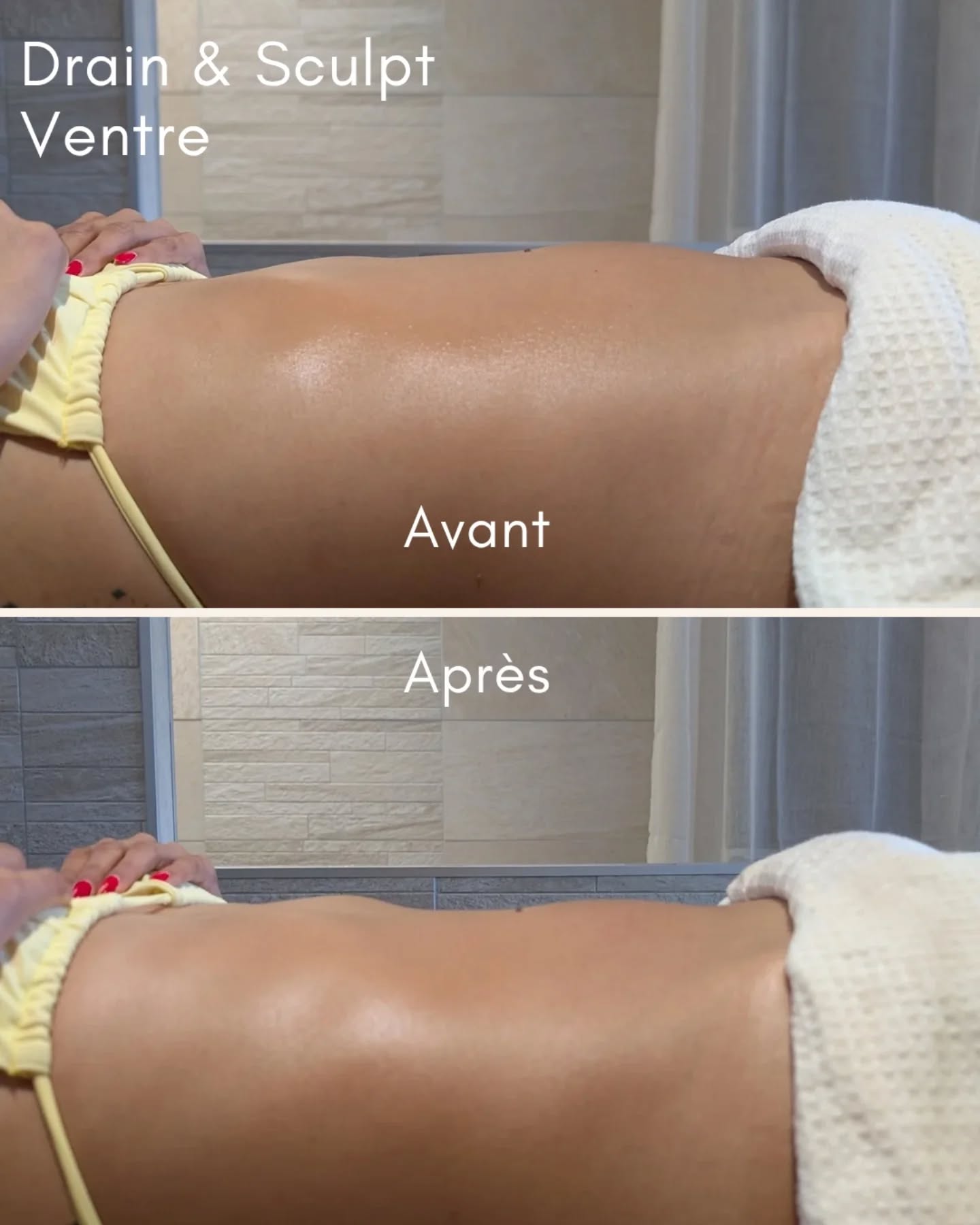 MADERO DRAIN & SCULPT / Des changements visibles
Technique naturelle et ultra efficace.
Un soin combinant Drainage Lymphatique, Madérothérapie et Travail Viscéral.
Une circulation stimulée, un corps désengorgé, une silhouette affinée.
Zones ciblées : ventre et taille
Résultat obtenu après une séance ! Un ventre dégonflé et sculpté !
Alors dis moi, quelles zones souhaiterais-tu qu'on affine ??
N'hésites pas à m'envoyer un message si tu as besoin de renseignements !
RDV également sur Planity lien dans ma Bio !