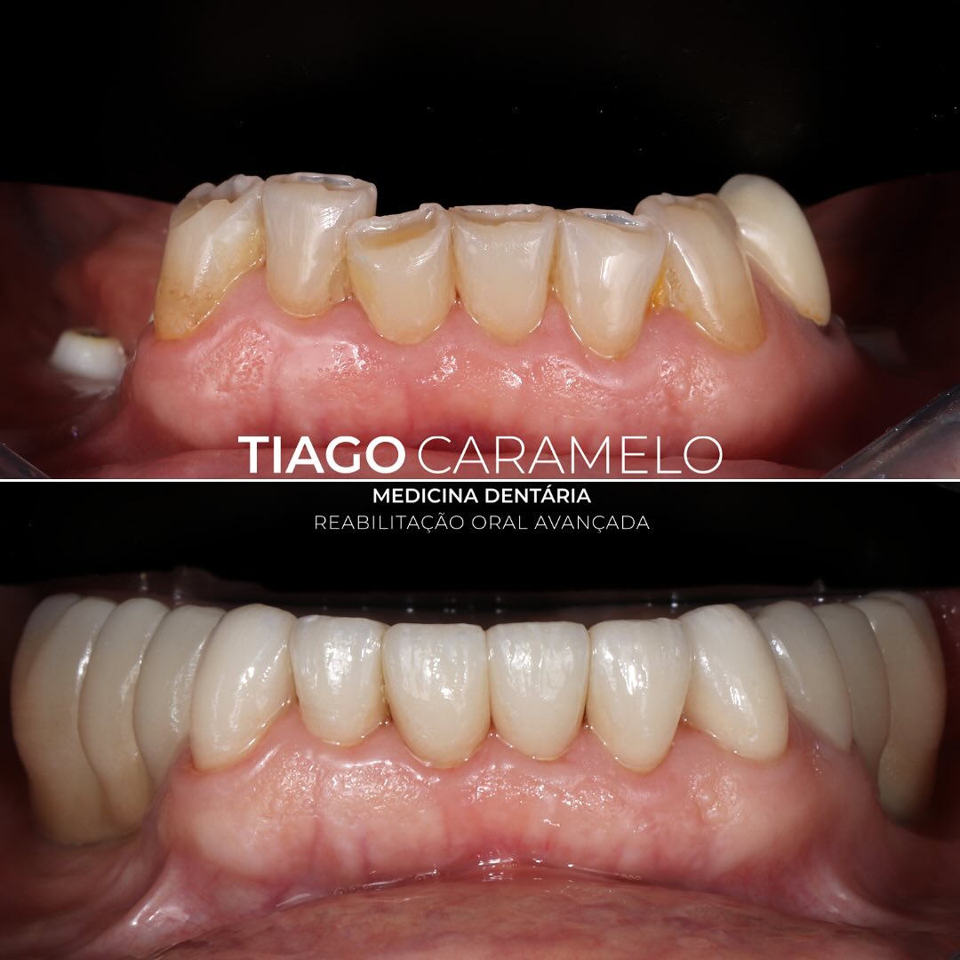 Caso de reabilitação total cerâmica no maxilar inferior que apresenta os diversos tipos de tratamentos na área da prostodontia: facetas cerâmicas, coroas cerâmicas sobre dentes e coroas cerâmicas sobre implantes. Este tratamento realizado permitiu repor o desgaste dentário acentuado, compensar o desalinhamento dentário e repor as ausências de dentes posteriores.
Após esta reabilitação, a paciente ganhou não só estética e função mastigatória, como também conforto, confiança e felicidade para encarar o seu dia a dia.
Trabalho laboratorial realizado por @sandraumbelino
—————————————————————————————-
Case of full ceramic rehabilitation of the lower jaw, showcasing various types of prosthodontic treatments: ceramic veneers, ceramic crowns over natural teeth, and ceramic crowns over implants. This treatment allowed for the restoration of severe dental wear, the correction of dental misalignment, and the replacement of missing posterior teeth.
Following this rehabilitation, the patient gained not only aesthetics and masticatory function but also comfort, confidence, and happiness to face daily life.
Laboratory work by @sandraumbelino
#ceramiccrowns #veneer #implant #oralhealth #oralrehabilitation #maloclinic