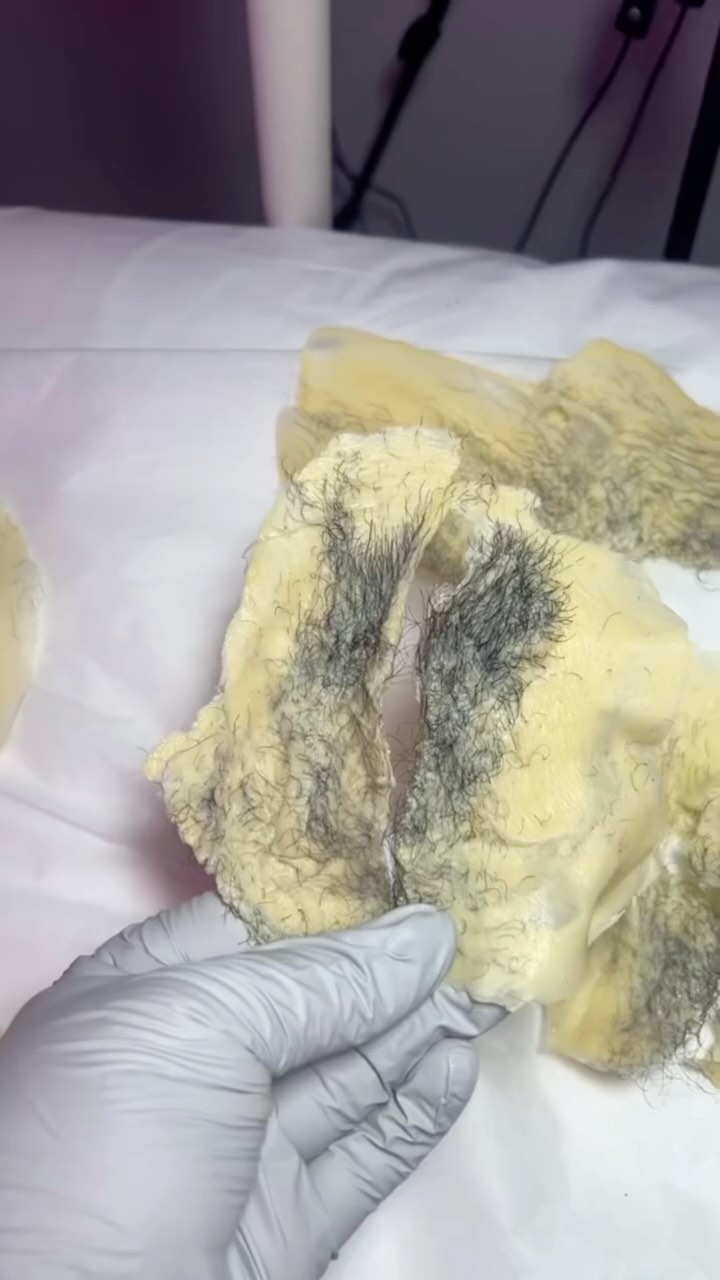 Waxing is a temporary hair removal process that involves applying wax directly to the skin and then removing the hair and wax all at once. What is a Brazilian wax? A Brazilian wax is a waxing service that completely removes pubic hair from the front, upper thighs, and butt. Based on your personal preference, you can leave a small strip of hair, a triangle, or square on the front.
Did You Know :
Waxing weakens the papilla, which can eventually stop hair growth. However, because each individual hair within the same follicle is in any one of the three stages at once, waxing only destroys the hair in the follicle they are in the anagen phase with each waxing service.
#waxspecialist #bodywax #waxingspecialist #legwaxing #eyebrowwax #facialwaxing #browwaxing #fullbodywaxing #facials #bodywaxing #Atlantawax #Atlwax #fyp #explorepage #bodycontouring #Bodysculpting #atl #Atlanta #Facial #facials#Foryoupage #Waxing #waxatlanta #Waxatl