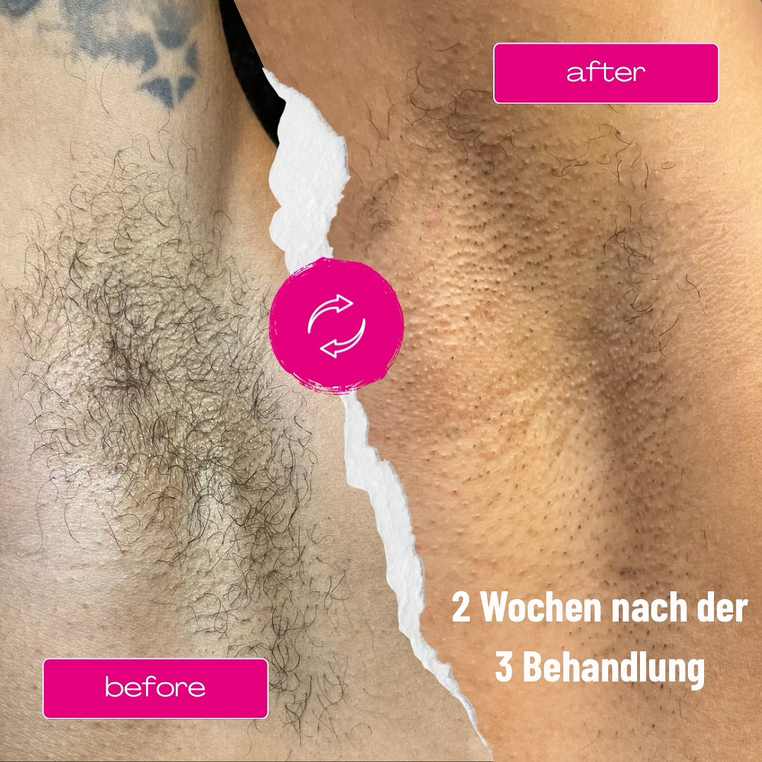 Yes, we can – auch bei dunkler Haut! ✌🏽✌🏿✌🏻✌🏼
Die Ergebnisse sprechen für sich: Nur 2 Wochen nach der 3. Behandlung ist das Haarwachstum deutlich reduziert!
Dauerhafte Haarentfernung funktioniert bei allen Hauttypen – sicher, effektiv und hautschonend.
Du bist unsicher, ob Laser bei deinem Hauttyp geeignet ist? Komm vorbei, wir beraten dich individuell und kostenlos!
#laserhairremoval #afrodeutsch #vorhernachher #tigerlilywaxing #tigerlilylaser #haarfrei #blackwomen #brownskingirls #dauerhaftehaarentfernungberlin #laserhaarentfernungberlin