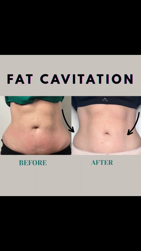Ready to slim down WITHOUT surgery? ✨
ProCare Fat Cavitation is your non-invasive solution to your stubborn fats!
Using advanced radiofrequency and ultrasound technology, it targets and breaks down fat cells, which are naturally eliminated by your body.
No pain.
No downtime.
Just visible results—especially around the tummy, thighs, arms, and love handles. 💪💖
Book your session today and start your body contouring journey at Kew Skin Therapy.
https://www.kewskintherapy.com.au/
Kew Skin Therapy
📍174 High Street, Kew, VIC 3101
📞(03) 9853 4544
#KewSkinTherapy
#BodyGoals #ProCareCavitation
#Fatcavitation #NonSurgicalSlimming #Highlights
