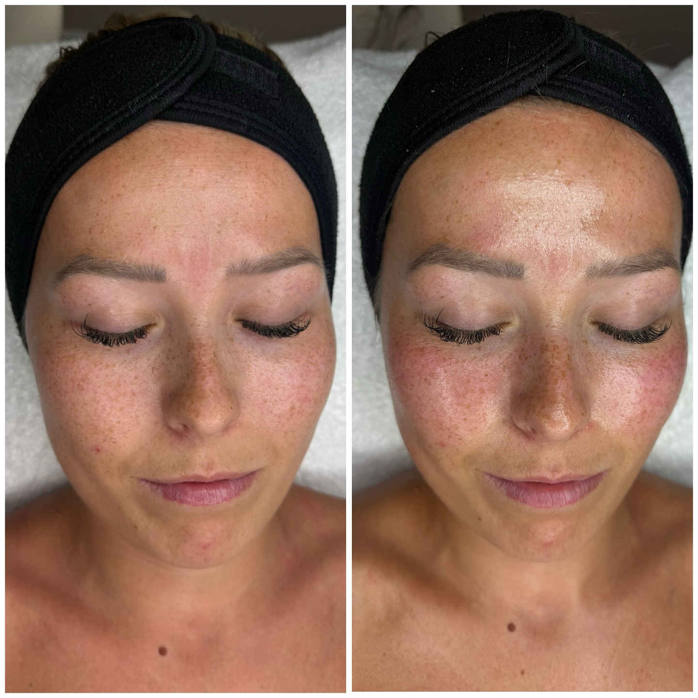 Can we just take a minute for this beauty and her amazing Oxy Pro result!! 🥰
🫧The Oxy Pro facial delivering glowing skin time and time again, breathing new life into the skin 🫧
This treatment involves non-strenous facial yoga which boosts circulation, bringing more oxygen to the cells meaning a reduction in stress and inflammation and resulting in healthier more radiant skin 💫
Available at Jessica Abbott Cosmetics in Barham
and Birchington
#GlowingSkin #HealthySkin #skinrejuvenation #selfcare #glassskin