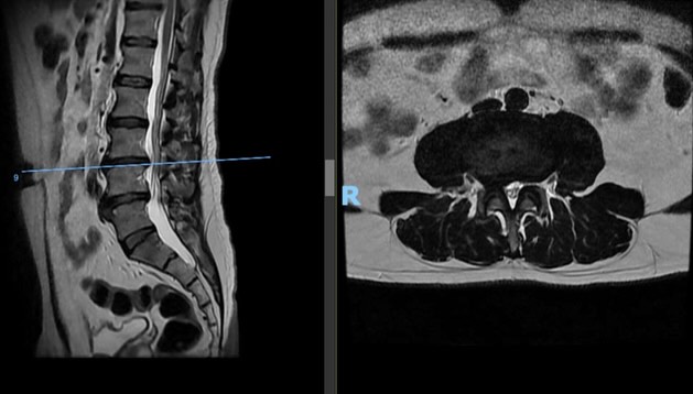 La enfermedad discal degenerativa en la columna lumbar puede venir acompañado de dolor en espalda baja y dolor radicular (ardoroso/calambroso) que puede tratarse con un enfoque regenerativo sin necesidad de llegar a la cirugía o retrasando la necesidad de esta.