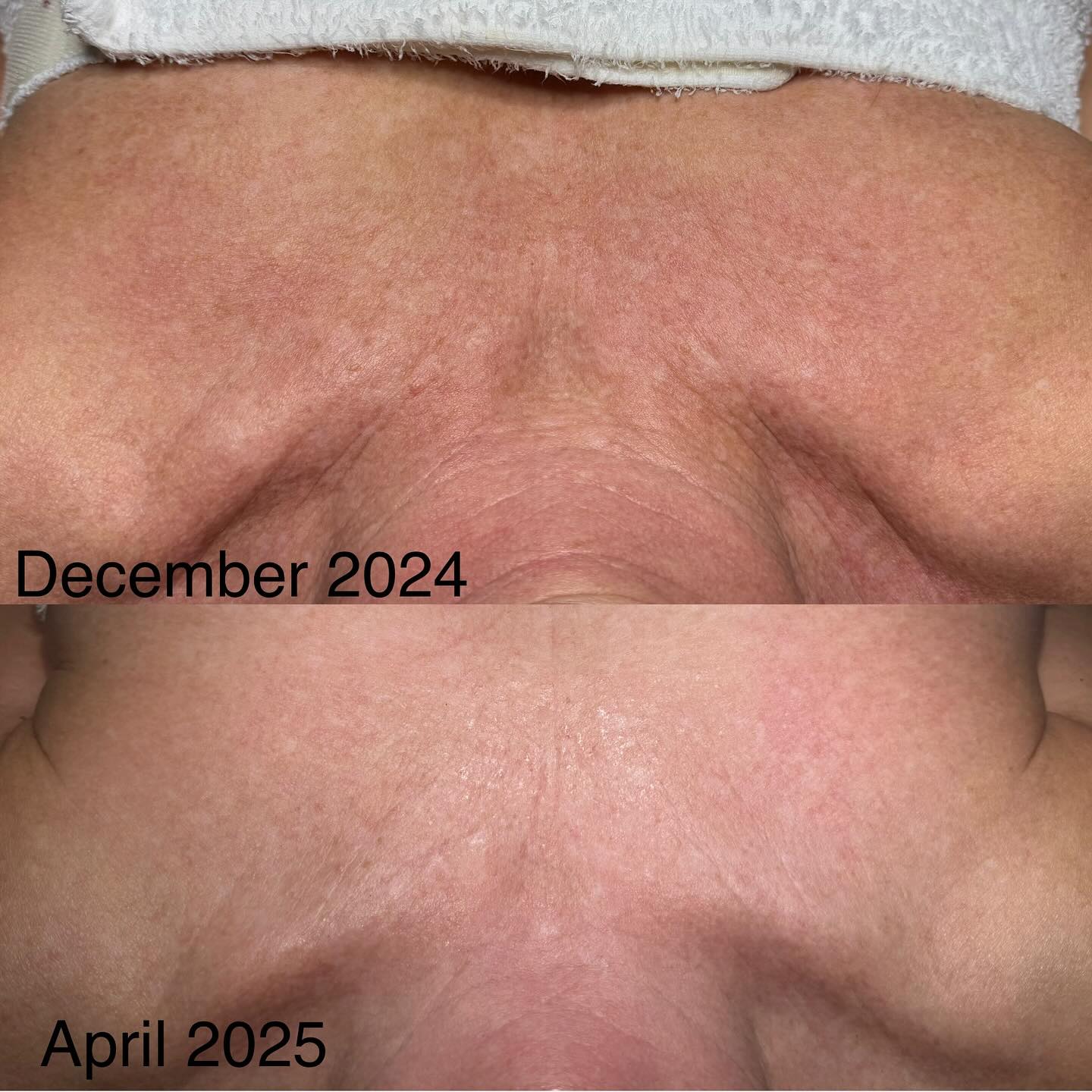 If you have been wanting to get a peel now is the time before the weather heats up for summer. Remember results WILL NOT always be immediate. Trust the process 🫶🏽
Used @circadia mandeliclear peel & Vitamin A for the win 🙌🏽
•
•
•
•
#CircadiaPeels#CircadiaFacials#OCFacials#OCEsthetician#HyperpigmentationPeel#SkinCareResults