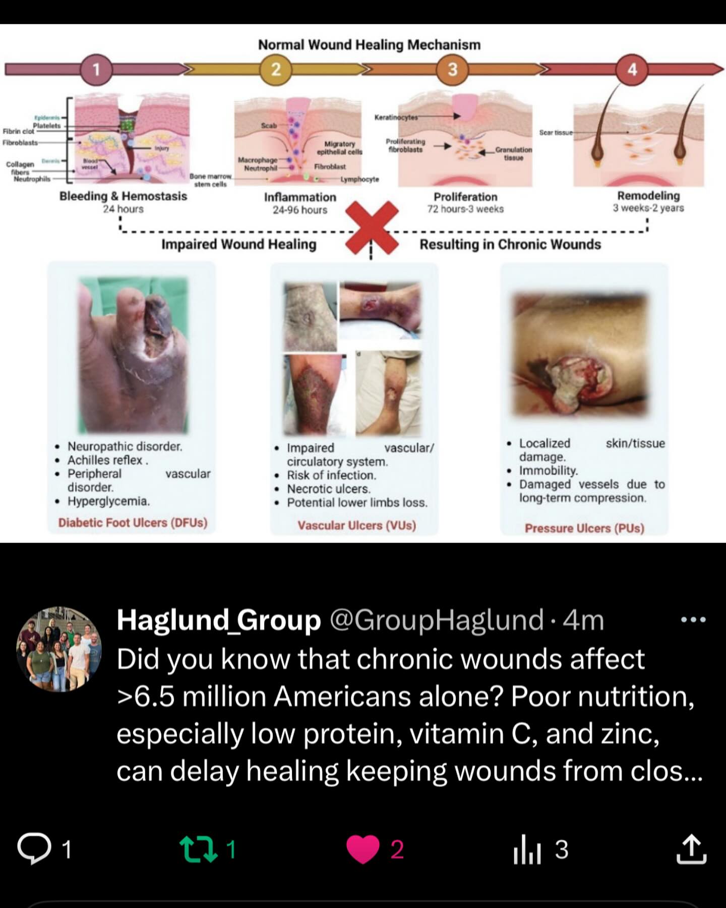 Did you know that chronic wounds affect >6.5 million Americans alone? Poor nutrition, especially low protein, vitamin C, and zinc, can delay healing keeping wounds from closing. Balanced nutrition and managing conditions like diabetes can enhance your body’s ability to heal.
Reference:
https://advanced.onlinelibrary.wiley.com/doi/10.1002/adhm.202300556
#chronicwound #woundhealing #funfacts #funfactfriday #funfact #scientificfacts #hawaii #universityofhawaiiatmanoa #uhm #universityofhawaiia #uh #science #DNA #chromosomes #researchgroup #haglundgroup #drhaglund