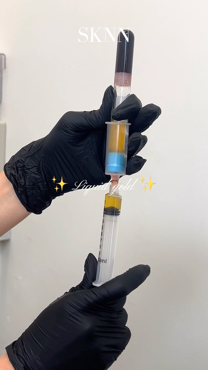 ✨ Platelet-Rich Plasma ✨
Benefits:
Promotes collagen production
Reduces fine lines and wrinkles
Improves skin texture
Helps with acne scars, pigmentation, and overall skin tone.
The PRP boosts the healing process, enhancing the effectiveness of microneedling, leaving your skin looking radiant, smooth, and refreshed with minimal downtime ✨🤌🏻
Book your appointment by clicking the link in our bio!
Sknn Aesthetics | Tricities Medical Spa
West Pasco
#tricitiesnurseinjector #glowingskin #medspa #injectorthings #antiaging #smoothskin #prp #microneedling #richplasma