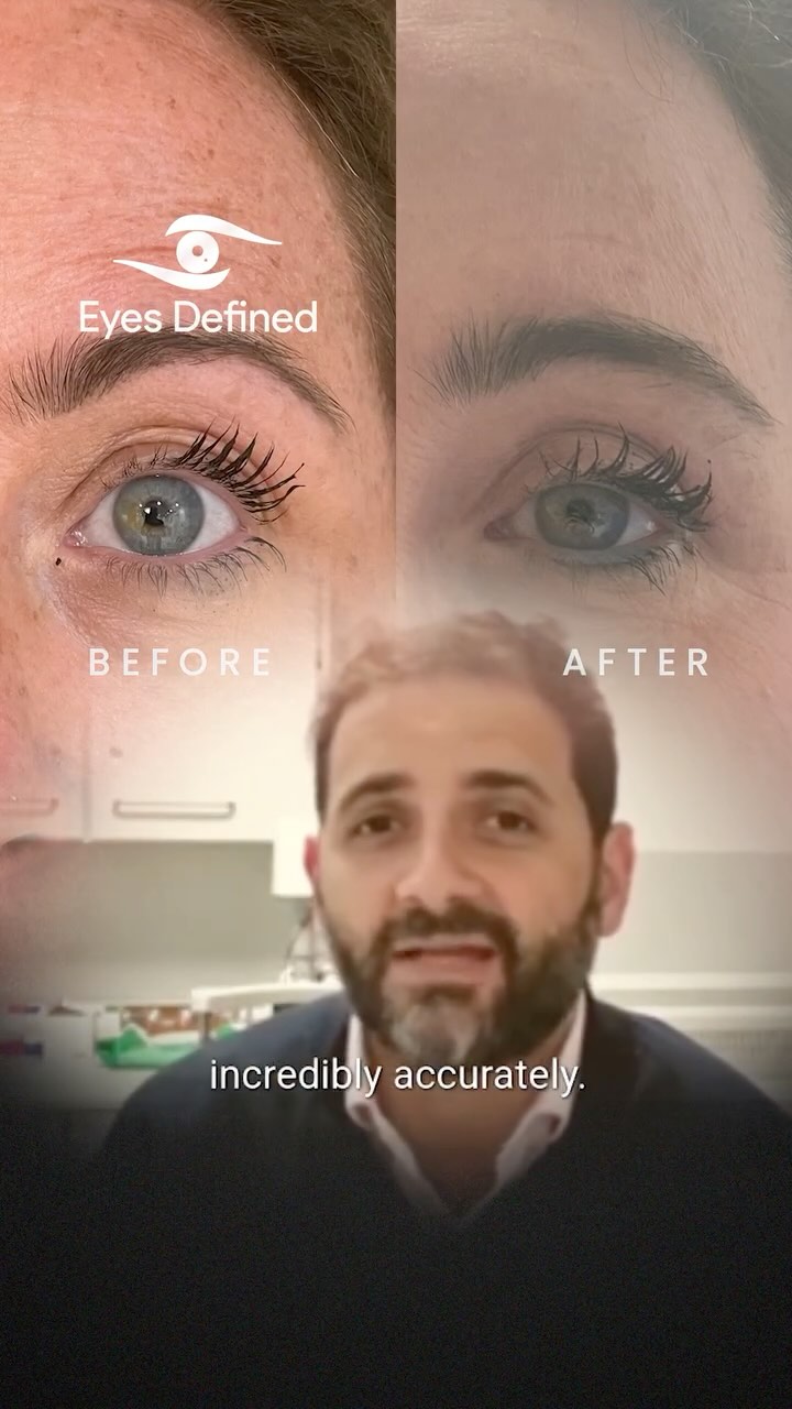 Different words mean different things to different people. Try to be objective with your surgeon and avoid miscommunication. This can make sure that you are both on the same page and that you get the best results possible! #miscommunication #cosmeticsurgery #blepharolasty #happypatient