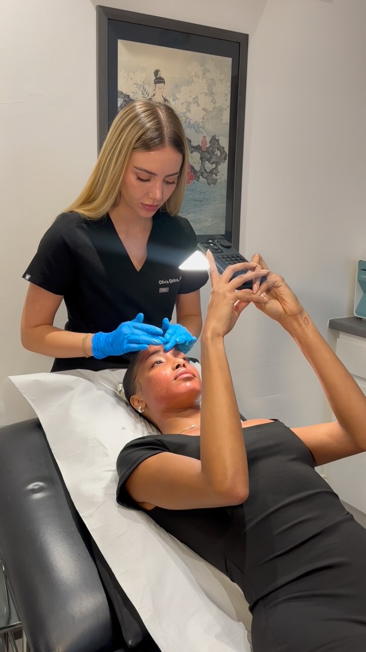 PRP microneedling to address scarring for the beautiful @iamangejose 💞
#microneedling #prp #prplondon #chickenpoxscars #acnescars #naturalaesthetics #aestheticslondon