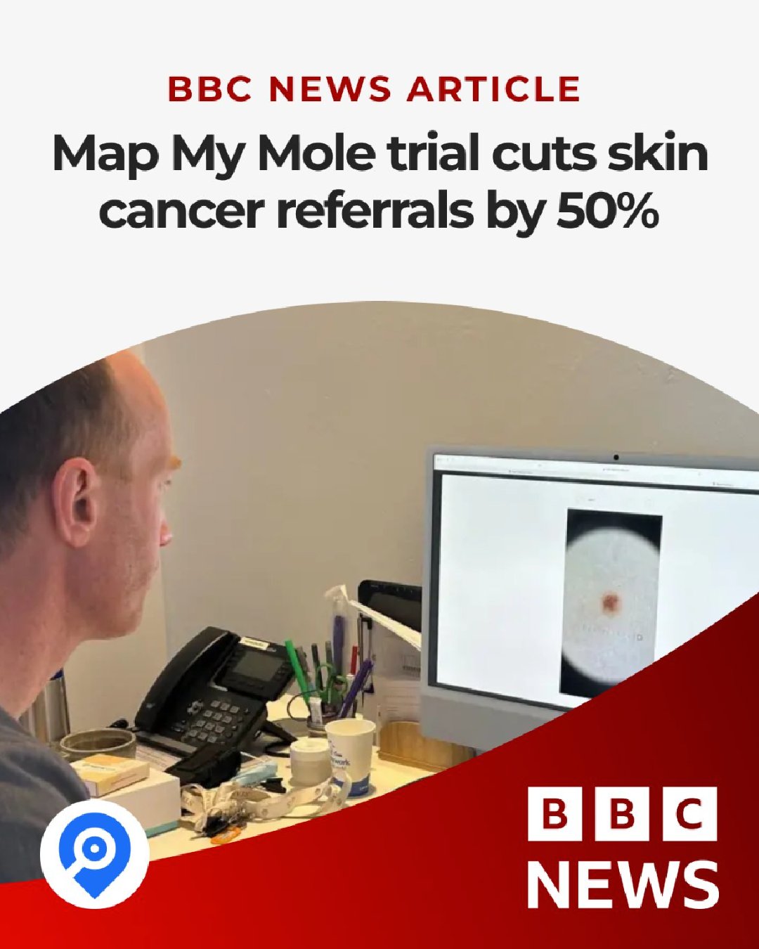 The amazing Map My Mole has been featured in a BBC News article!
Accessible mole mapping is truly changing the way skin cancer is detected and diagnosed.
Map My Mole's pilot program with the NHS in Devon and Cornwall has already reviewed over 1,500 moles and lesions, reducing hospital referrals by 50%. This kind of innovation and technology provides patients results within days, reducing the strain on the NHS whilst ensuring nothing suspicious is missed.
We're incredibly proud to offer this service at The Expert Skin Clinic. To book, head to our website, click 'book now' and search for the 'mole/lesion screening'.
#mapmymole #molescreening #molescreeningclinic #skincancerscreening #skincancer #molemapping