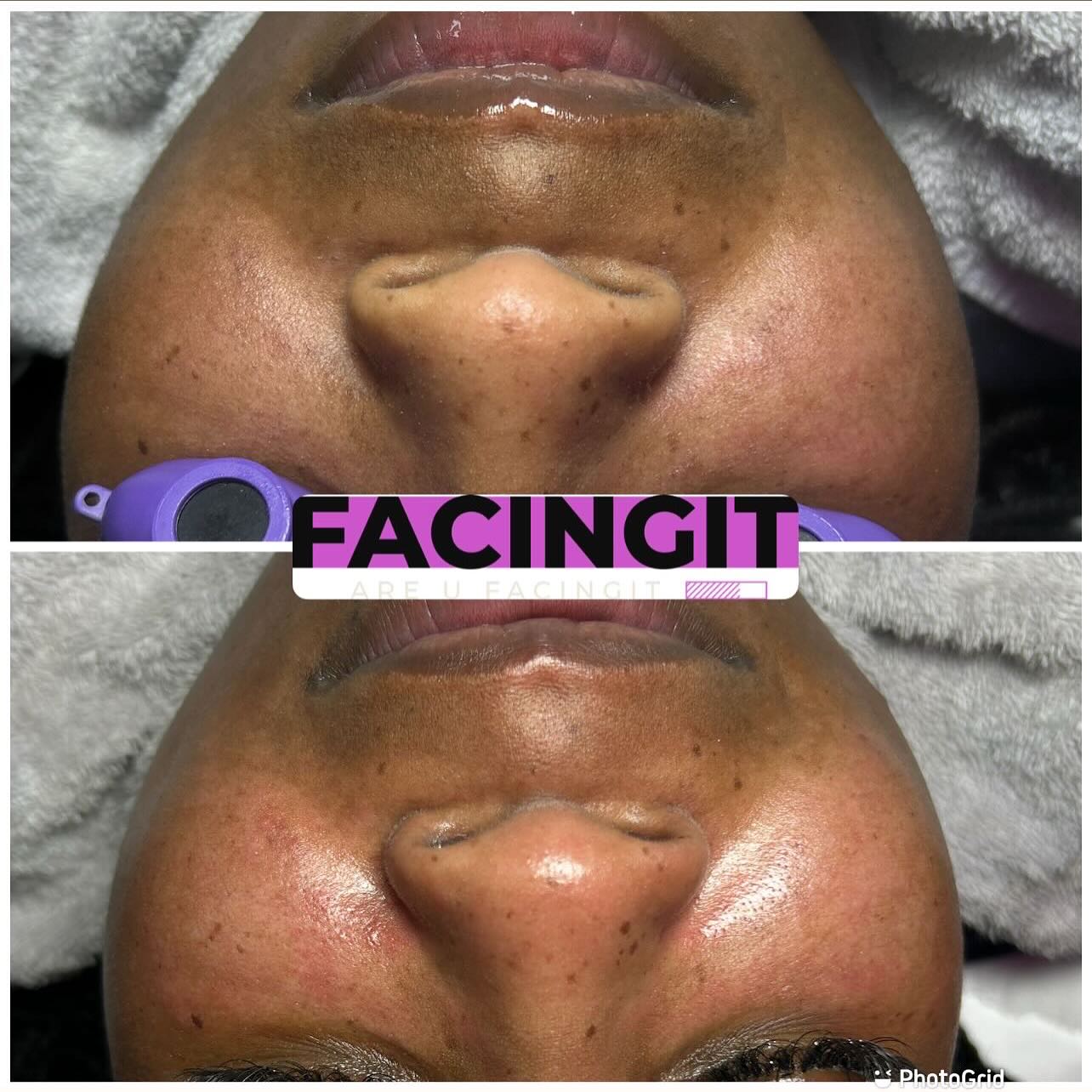 Diamond Microdermabrasion Facial Are You booking to get your skin cleanse and refresh or JUST LOOKING ???????????
Tired of dry itchy skin? Dead skin on your face?? Did you know with the seasons changing your skin will change as well! Let me help you maintain a natural balance for your skin care.
https://www.aubriafacingit.com/
The seasons is changing & cold-weather is upon us. Remember your skin changes as well. Do your skin seems more dry, irritated, & itchy. Or maybe you see more red and white bumps or your acne or eczema it’s starting to flare up more. Book a session with me and I can help with your every needs. Book here at my website at www.aubriafacingit.com . Look over all my service and see what best fit for you. Hit the chat button online for immediate response.
#dermaplaningfacials #facialatlanta #atlantaspa #atlantaskincare #clearskin #explorepage #vacuumtherapy #facials #lymphaticdrainage #collegeparkga #blackesthetician #eastpointga #Atl #beautiful #facialsatl #spaday #menfacial #dayspa #hairremoval #aesthetics #facialtreatment #blackowned #estheticianatlanta #facingit #extractions #atlanta #naturalskincare #blackheadremoved #atlantastylist #atlantahairstylist