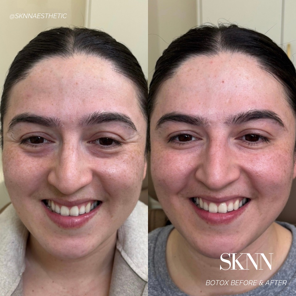 At SKNN Aesthetics, we believe in enhancing your natural beauty with the subtle magic of Botox. From smoothing forehead lines to softening crow’s feet, it’s time to refresh, renew, and reveal your most confident self. Start your Botox journey with us today ✨
Book your appointment by clicking the link in our bio or send us a message ✨
Sknn Aesthetics | Tricities Medical Spa
West Pasco
#tricitiesnurseinjector #botox #antiaging #botoxtricities #injectorgoals #botoxforehead #botoxinjections #botoxbeforeandafter #finelines #wrinkles
