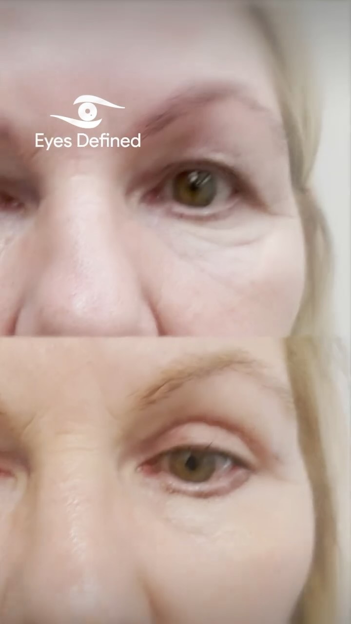 ✨ Bright-eyed & Beautiful ✨
Just 3 weeks post-op and the transformation speaks for itself! This lovely patient underwent an upper eyelid blepharoplasty, lower eyelid skin pinch blepharoplasty, and bilateral canthopexy — restoring a more youthful, refreshed appearance while maintaining her natural look.
No filters. No tricks. Just expert technique and meticulous care. 👁️✨
If you're noticing heaviness or tiredness around the eyes, you may be a candidate too. Consultations available in London.
📍 Harley Street, London
💬 DM to book a consultation
#EyelidSurgery #BlepharoplastyLondon #OculoplasticSurgeon #EyelidLift #UpperBlepharoplasty #LowerBlepharoplasty #SkinPinch #Canthopexy #EyeRejuvenation #LondonSurgeon #HarleyStreetExpert #YouthfulEyes #NaturalResults #PlasticSurgeryLondon #FacialAesthetics #RefreshYourLook