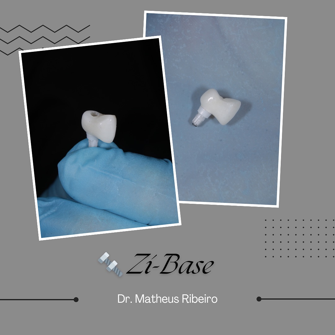 Você já ouviu falar na Zi-base? 🤔
Ela é uma base de zircônia usada em coroas parafusadas sobre implantes, ideal para quem busca estética sem abrir mão da resistência! 💪🦷
Indicada principalmente em áreas estéticas, a Zi-base evita o temido “cinza do metal” na gengiva e oferece uma excelente adaptação e biocompatibilidade.
⠀
✨ Resultado mais natural
🛡️ Maior resistência à fratura
🦷 Sem metal exposto
⠀
Uma escolha inteligente para casos onde a estética faz toda a diferença! 💡
⠀
#OdontologiaEstética #Zircônia #zibase #ImplantesDentários #PróteseSobreImplante #Dentista#facetas #lentes #implantes #saudebucal #odontologia #tratamentoodontologico #dente #estetica #anapolis #implantezirconia #odontologiabiológica #odontolgiaintegral #odontologiabiologicaeintegrativa #dentistaanapolis #straumangroup