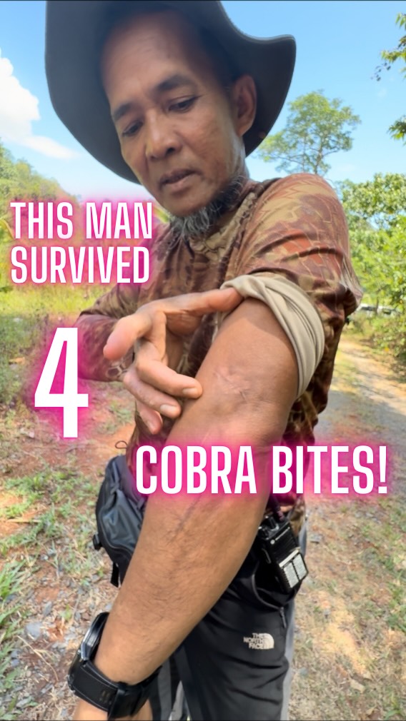 My colleague Osman has been bitten FOUR times by a Cobra and he has the scars to prove it!
He’s our professional snake handler on this film project, but (like all humans) he’s made mistakes, which have led to no fewer than four envenomations from common cobra in his career to date.
Cobra venom is primarily a neurotoxin, meaning it disrupts the nervous system. He told me how one bite knocked out the nerves controlling his eyelids resulting in eyelid drooping (ptosis).
The venom can also interfere with nerve conduction to the lungs which can result in respiratory (breathing) failure and potentially death. The administration of anti-venom from a nearby health facility can be a life-saving intervention.
He has also experienced swelling and necrosis (tissue break down) at the bite site which is another common complication. Unfortunately anti-venom is generally less effective at treating this.
If I’d had these experiences, I’m not sure I’d still be working with snakes. I admire his determination! 💪
#wildernessmedic #expedition #doctor #nurse #paramedic #wildernessmedicine #remotemedicine #prehospitalcare #frec #snakebite
@secret.compass @theadventuremedic @worldextrememedicine
@exewildernessmedsoc @wildernessmedglasgow @dundeewems @cardiffwems @buwms @leicester.wems @wemssgul @manchester.wms @notts_wms @wmsmededsoc @utk.wildernessmedicine @go_wme @wildernesscambridge @uclwildernessmed @wildernessmedicineclub.ucd @thewildernessmedic @wildernessmed__compnw @wildernessmedicineofutah @wildmedireland @wilderness.mss @taffs.tv @meresupplies @sheffieldwildernessmedicine @wildmedwednesday @wildmedsociety @wildernessdentistry @brumwildernessmedics @wildmedtraining @nclwilderness @wildmed @kclwms @auwems @uclwildernessmed @canadianwildmed @wemssgul