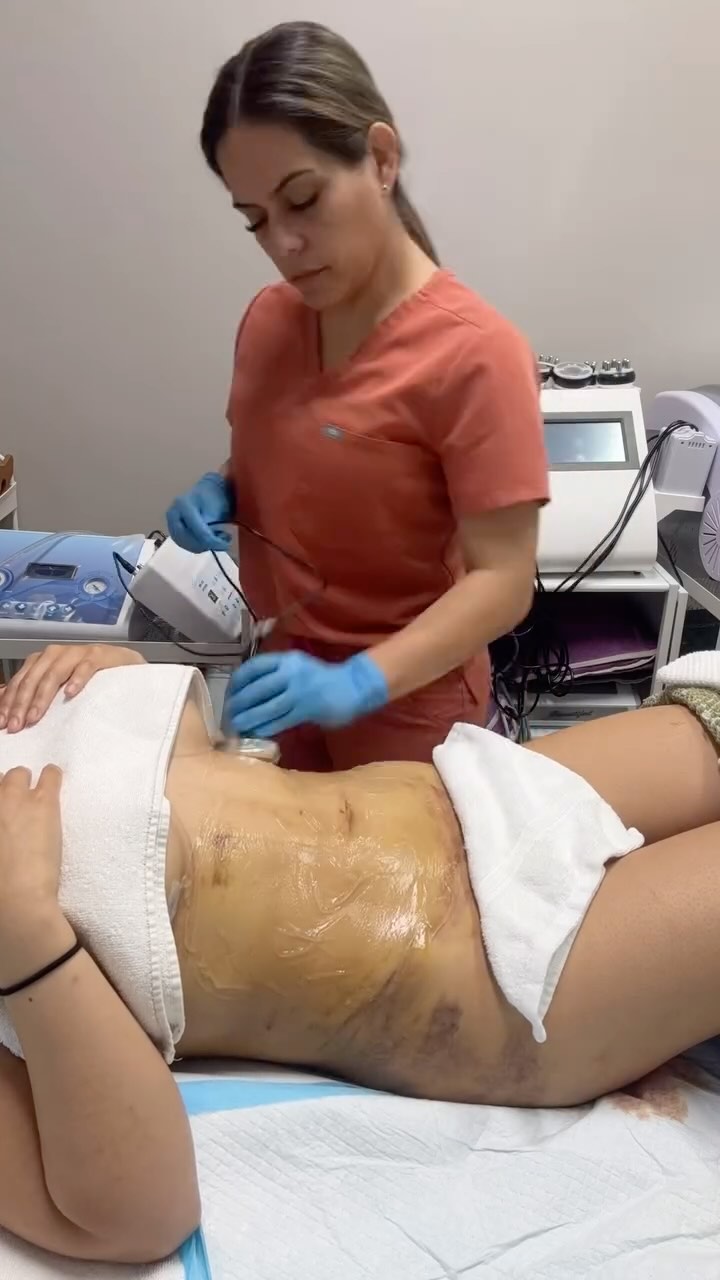 ¿Te hiciste una cirugía y aún estás inflamada? Los drenajes linfáticos post-operatorios son CLAVE para tu recuperación.🤗
#PostOperatorio #RecuperacionEstetica #SpaCare #CirugiaPlastica #CuidadoPostOperatorio #BellezaReal #Desinflamate