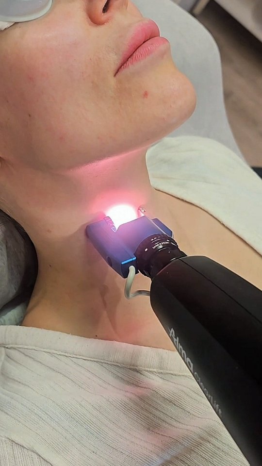 Alma laserhoidoissa tutustumistarjouksia. Valikoimassa vahvempi fraktionaalinen Erbium hoito ja kevyempi heleyttävä laserhoito. ✨️ Lue lisää, laita tarvittaessa yksityisviestiä tai tule ensin konsultaatioon.
#almalaser
#laserhoidot