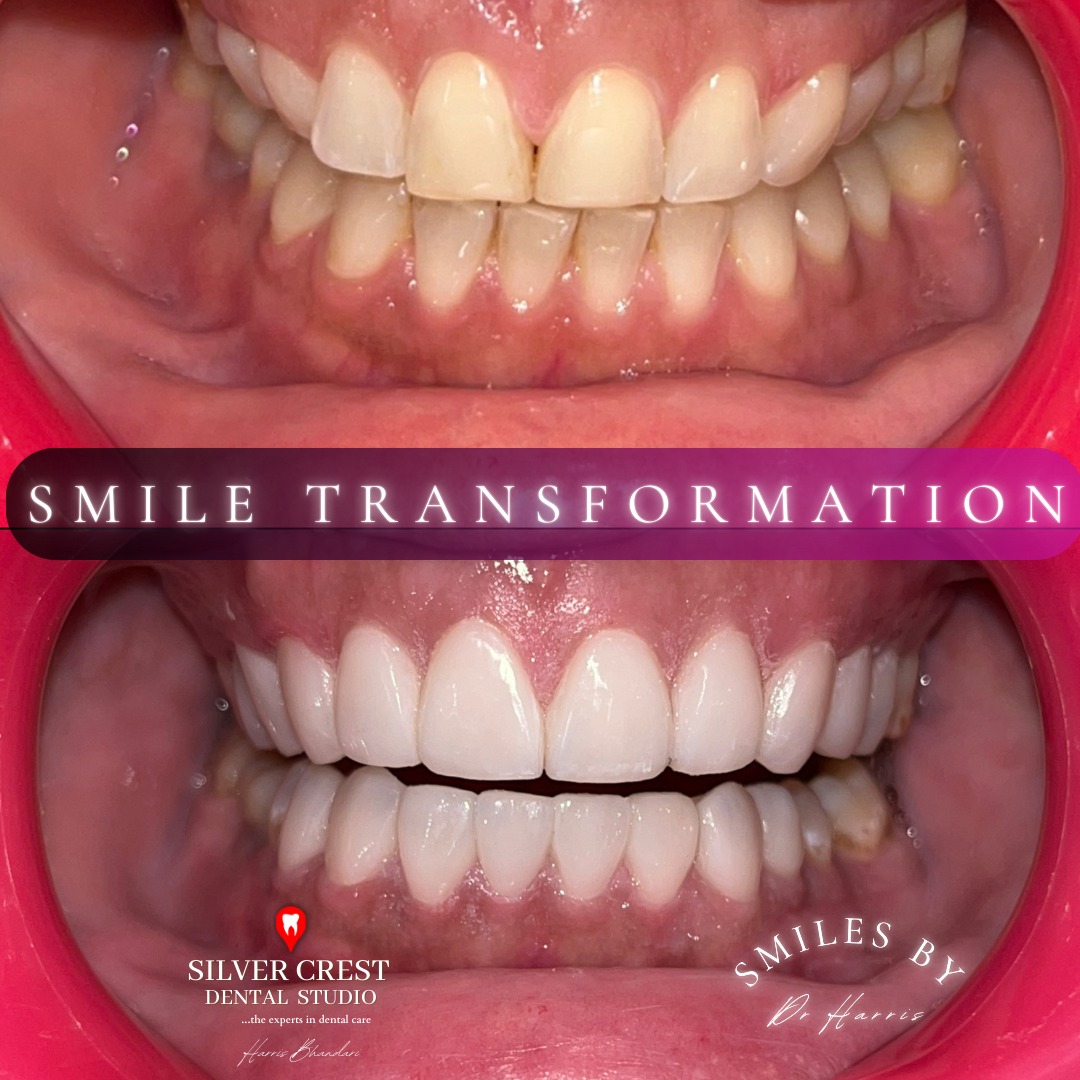 Porcelain Veneers - because first impressions matter! ✨
#smilemakeover #porcelainveneers #veneers #smiletransformation #confidenceiskey #confidentsmiles