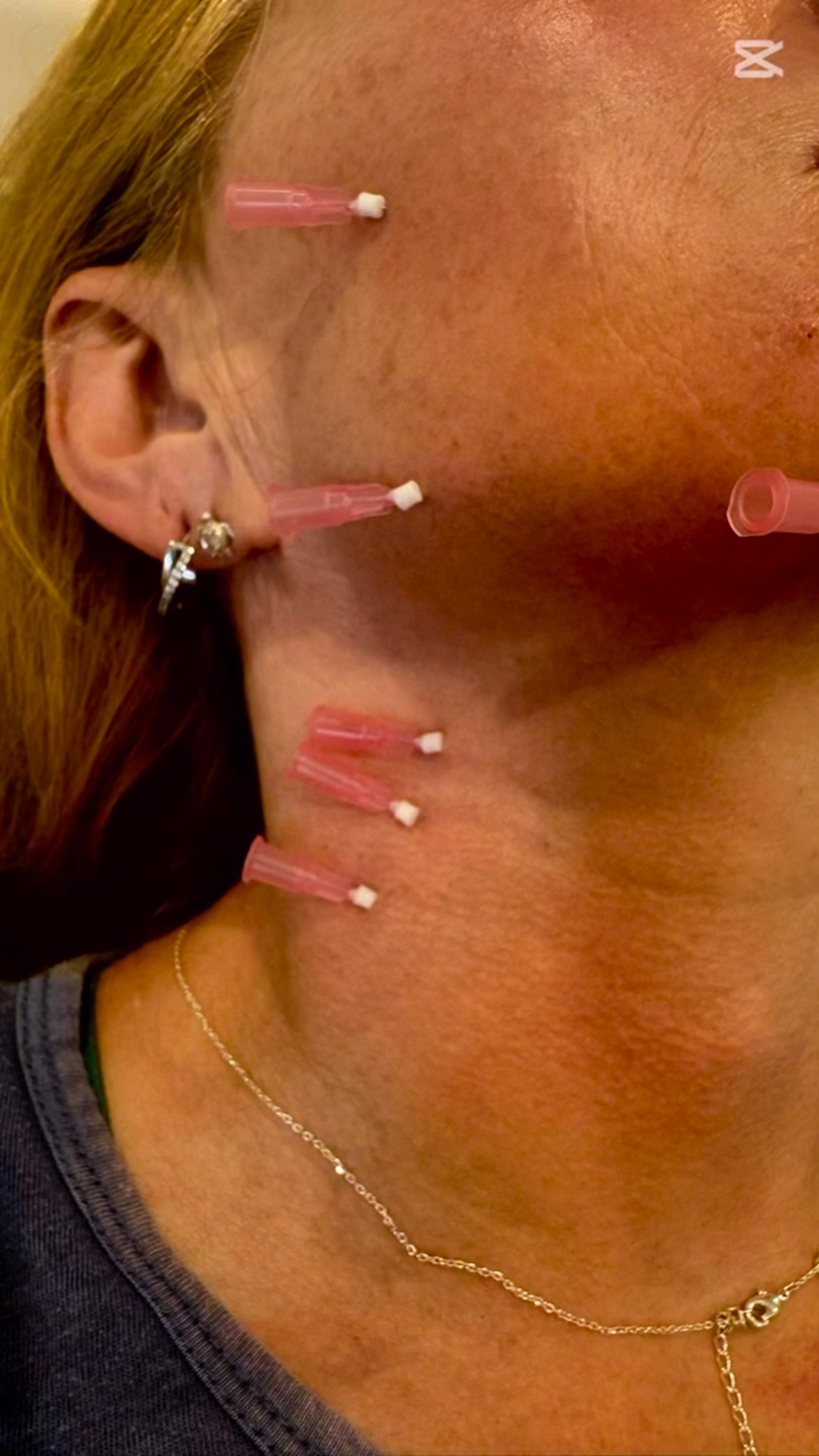 Definisse™ revitalise threads are the next generation of threads designed specifically for bio-stimulation and revitalisation. They promote long-lasting regeneration, added firmness and improved skin quality with a lasting glow - in both young and mature skin.
These threads smooth and firm the skin by stimulating both Collagen Type 1 and 3 production. Skin elasticity and hydration are increased resulting in a boost in overall skin quality. You will notice a difference in both texture and appearance.
Definisse™ revitalise threads are simple, quick and relatively pain free - they are set to be your new go-to treatment for glowing and healthy skin. Whether you would like firmer and tighter skin on your face, neck or abdomen Definisse™ revitalise threads have got you covered
When we are young our skin naturally produces collagen keeping it supple and soft, but as we age the skin’s ability to replenish collagen naturally decreases by 1.0 % – 1.5 % per year - and this is what causes the appearance of fine lines and deeper wrinkles.
Definisse™ revitalise threads improve skin quality by retaining and increasing collagen production, and in doing so, slow down the aging process. Whether you’re young and want to maintain your youthful glow, or more mature and want to gain it back, Definisse™ revitalise threads are for you.
Our revitalising threads are approved for a number of indications:
As early as our 20s collagen production slows down and we can benefit from preservation of elasticity and reduction of fine lines. Sagging skin in the mid or lower face can be corrected in those of us a little older, e.g. 45–65 years. Even crepey, sagging skin in the neck area when we approach our 60s can be improved.
And best yet, Definisse™ Revitalise Threads can help us tighten and lift loose abdomen skin, yes you heard right!
Call us for more information or a consult.
#revitalise #revistlisingthreads #threads #biostimulate #collagenboost #tighten #texture #glow #glowgetter #summervibes☀️ #noexcuse #medicallytrained #hampshire #hampshireliving #nodowntime
@relife_aesthetics
@enalionbeauty
@newenergyfitness