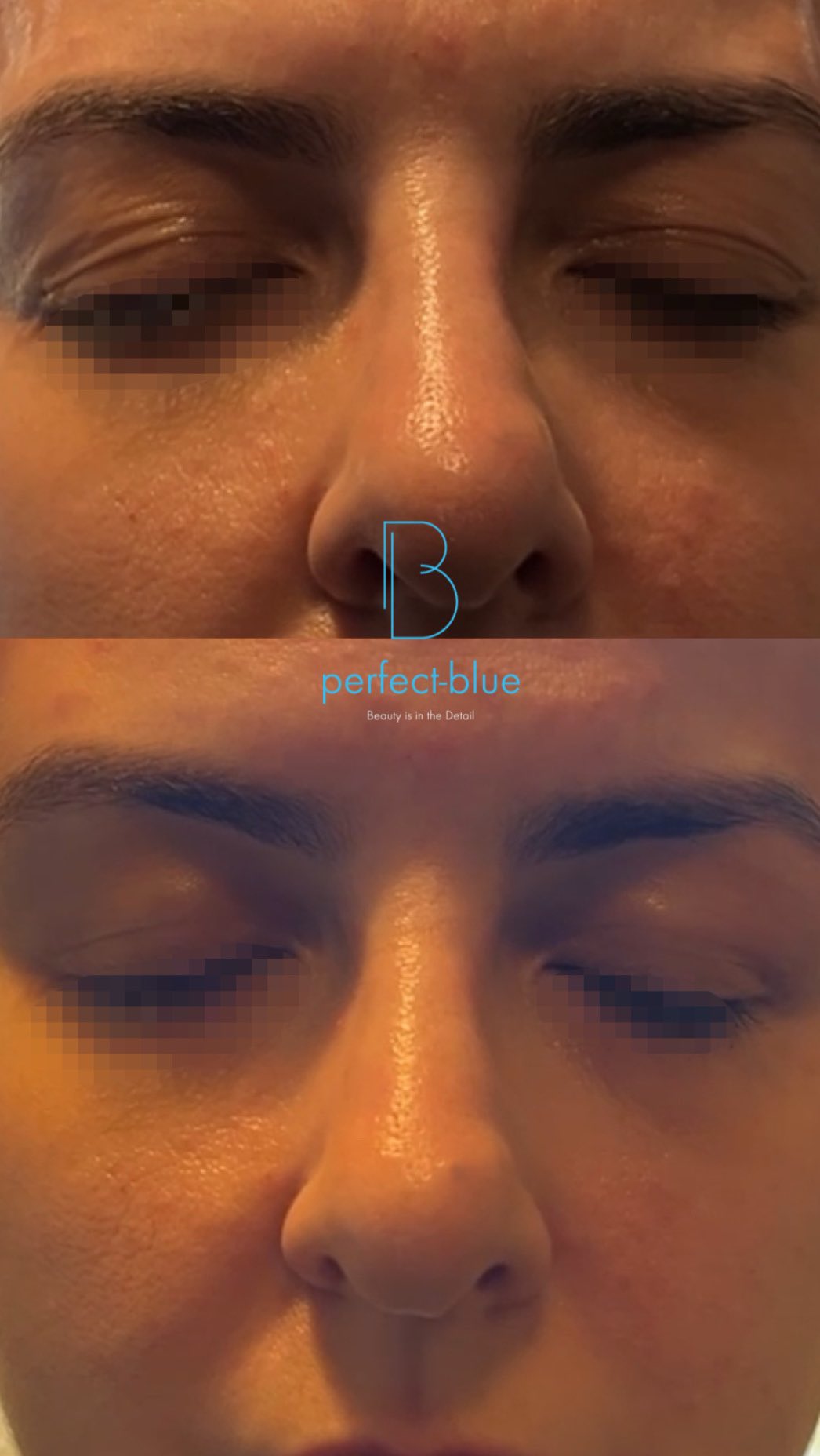 Instant brow lift με άμεσο αποτέλεσμα! ✨
Φυσικό look, εντυπωσιακή ανόρθωση και ξεκούραστο βλέμμα από την πρώτη στιγμή.
Η τεχνική με νήματα βεντάλια εφαρμόζεται με ακρίβεια και εξειδίκευση από τον Dr. Ektor, προσφέροντας αποτέλεσμα που ξεχωρίζει.
Το βλέμμα που θες, με τη φροντίδα που εμπιστεύεσαι.
Μόνο @dr.ektor
—
☎️ (+30) 210 72 58 982
☎️ (+357) 96 444 870
✉️ info@perfect-blue.com
💻 www.dr-ektor.com
—
#BrowLift #ThreadLift #FoxEyes
#DrEktor #PlasticSurgery #Athens
#Kolonaki #Cyprus #AestheticMedicine
#NaturalLook #GlowUp #HappyClients