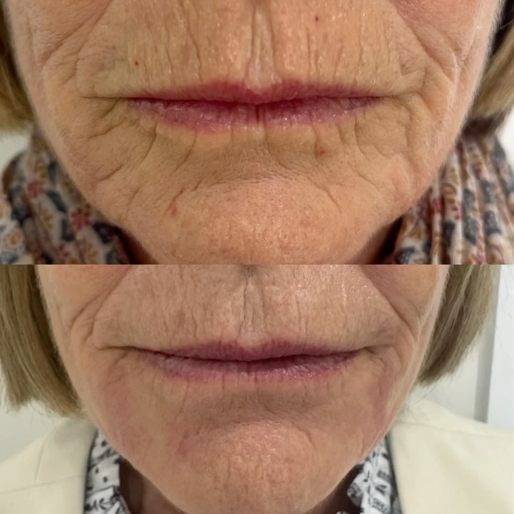 ⭐️⭐️Round two 🤩⭐️⭐️
We refined this area again targeting the marionette lines. I know we sound like broken records but you don’t have to look plastic. You really don’t have to do it all at once and you CAN build it up slowly and achieve your desired goal.
#slowandsteadywinstherace #smooth #hampshire #smallbusiness #trust #journey #skin #aesthetics #winchester #medicallytrained #wegotyou
@newenergyfitness
@enalionbeauty