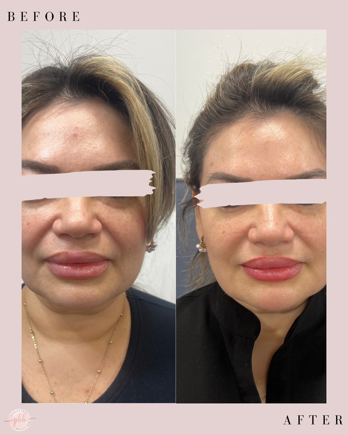 Just a little dermal filler pick me up. Refreshed!
.
.
To book an appointment, visit our website:
š www.prestigebeautybarinc.ca
.
.
.
.
#humberbay #neuromodulator #injections #AestheticGoals #dermalfiller