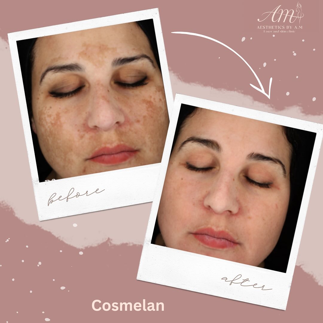 ✨ Say Goodbye to Stubborn Pigmentation with Cosmelan®️ ✨
Struggling with melasma, sun spots, or post-inflammatory pigmentation? 🌞 You’re not alone—and we’ve got the solution.
Introducing Cosmelan®️, the world’s leading professional depigmentation treatment—and your skin’s new best friend. 💆♀️💫
🔬 What is Cosmelan?
Cosmelan is a powerful, medical-grade peel designed to target and reduce hyperpigmentation at the source, regulating melanin production and restoring a beautifully even, radiant complexion.
🌟 Benefits of Cosmelan:
✅ Reduces melasma, dark spots & sun damage
✅ Improves skin tone and clarity
✅ Brightens and revitalizes dull skin
✅ Works on all skin types
✅ Minimal downtime with long-lasting results
💡 Results are noticeable in just a few weeks, with ongoing improvement as your skin renews. Pair it with proper aftercare and SPF, and you’ll love the glow that keeps on giving.
📆 Ready to transform your skin? Book your consultation today and take the first step toward even, luminous skin.
#Cosmelan #HyperpigmentationTreatment #AestheticsByAM #GlowingSkinJourney #MelasmaTreatment #SkinConfidence #AdvancedAesthetics #SkinClinicUK #aestheticsbyam #oxford #oxforduniversity #oxfordshire #oxfordlife #oxfordaesthetic