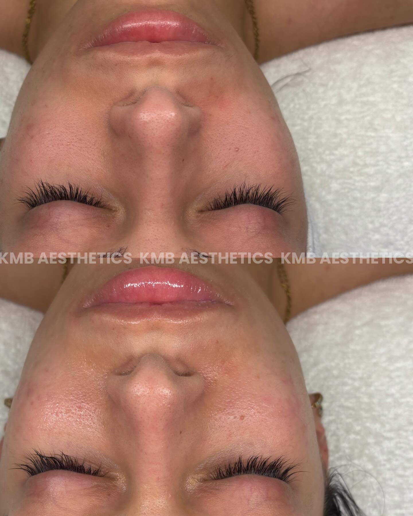 IMMEDIATE before & after of a Level 1 Fully customized treatment, targeting Eczema, congestion & dehydration. The results truly speak for themself 😍.
Barrier Repair is key to get properly functioning skin 🫧
BOOK NOW 🔗
#christianbusiness #christianskincare #christianentrepreneurs #browardfacials #browardfacialist #browardesthetician #browardacneclinic #browardacne #browardskincare #browardskincarespecialist #browardskincareproducts #browardskinclinic #southflfacials #southflfacialist #southflacneclinic