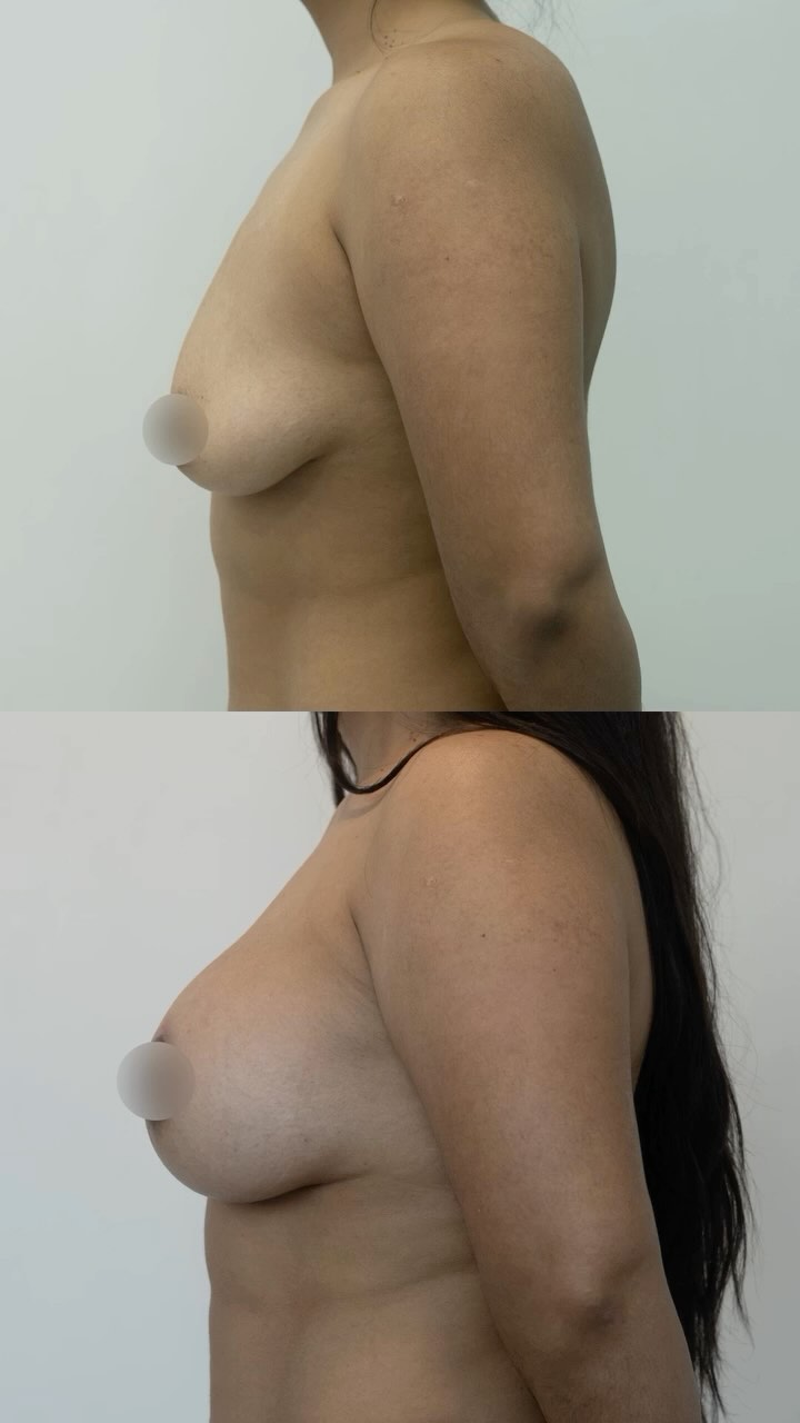 4 meses de evolución 🩵 un resultado natural para regresar el tiempo y potenciar. Combinamos la pexia periareolar y el aumento con implantes para lograr una Mastopexia 360° exitosa